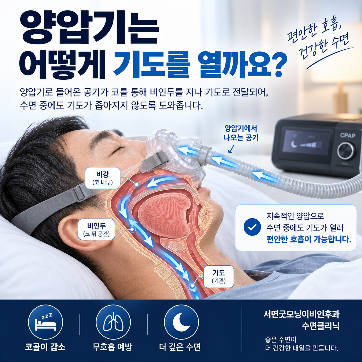양압기 공기 압력이 수면 중 좁아지는 상기도를 열어 두는 원리를 보여주는 대표 이미지