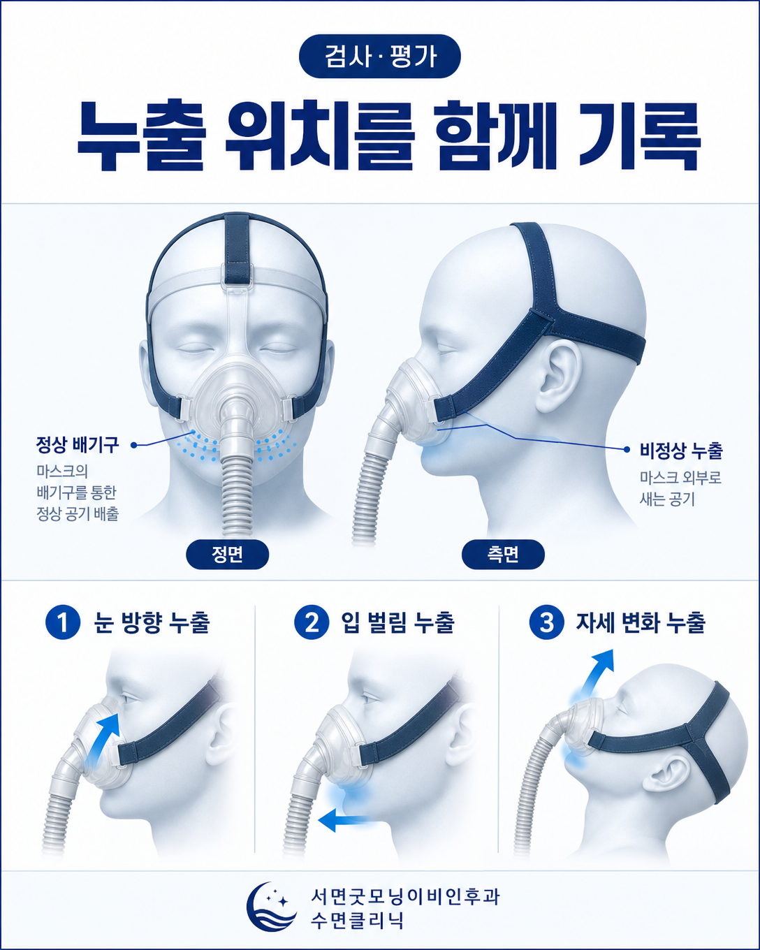 양압기 마스크의 눈 주변 누출, 입 누출과 자세에 따른 누출 위치