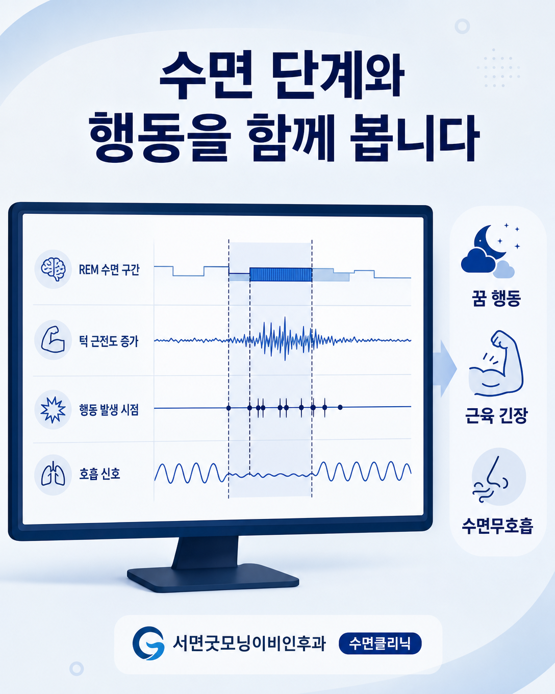렘수면 단계와 근전도, 행동, 호흡 신호를 함께 해석하는 수면검사 결과