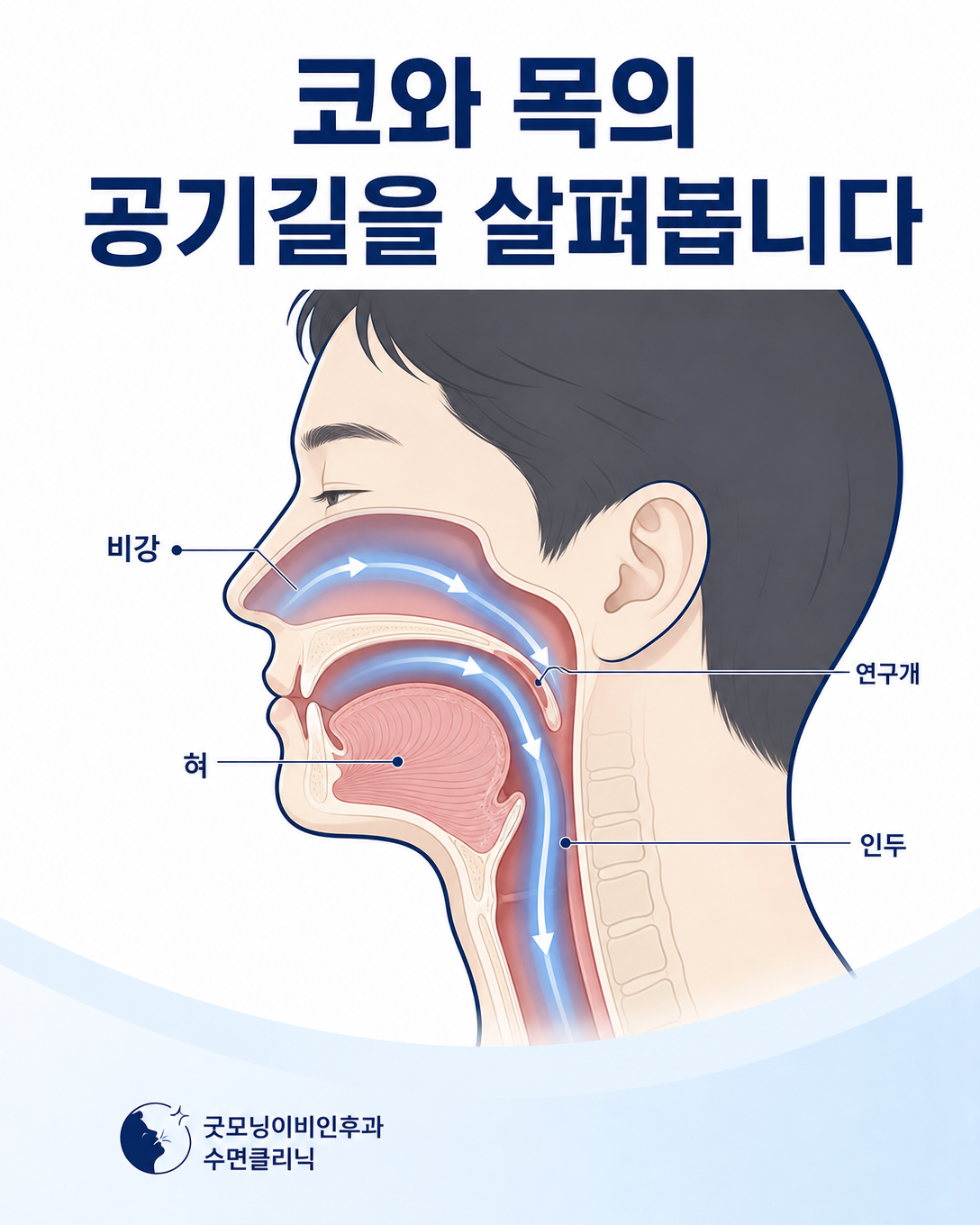 수면호흡 평가에서 확인하는 비강, 연구개, 혀와 인두의 상기도 구조