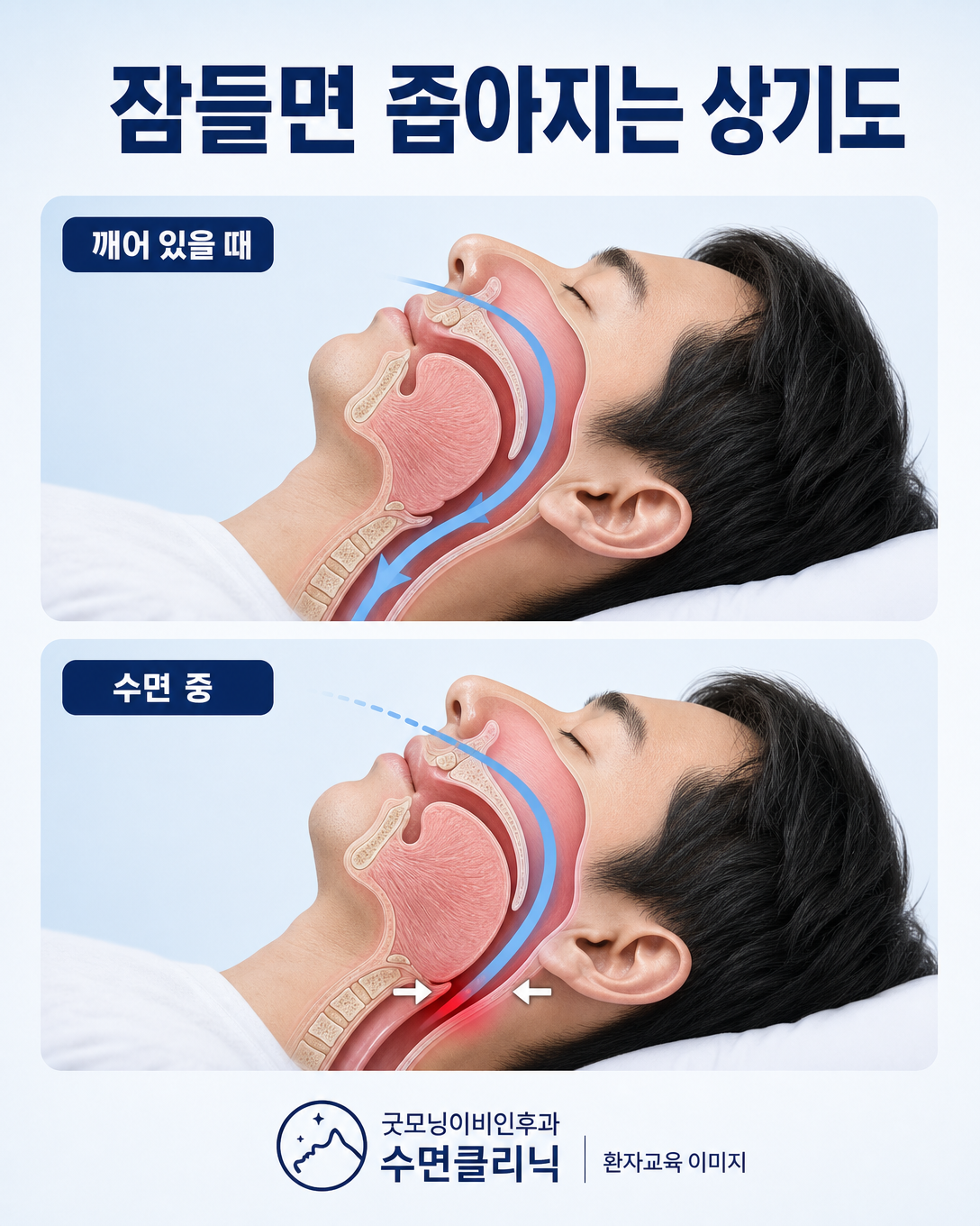 수면 중 혀와 목 주변 연조직이 이완되면서 상기도가 좁아지는 모습을 설명한 해부학 도식