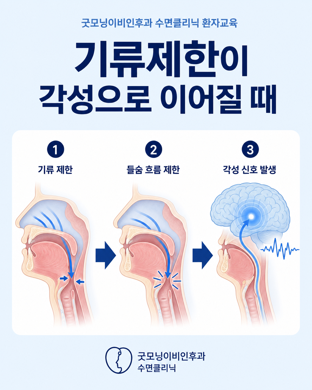 상기도 기류제한과 호흡노력 증가가 수면 중 뇌파 각성으로 이어지는 과정