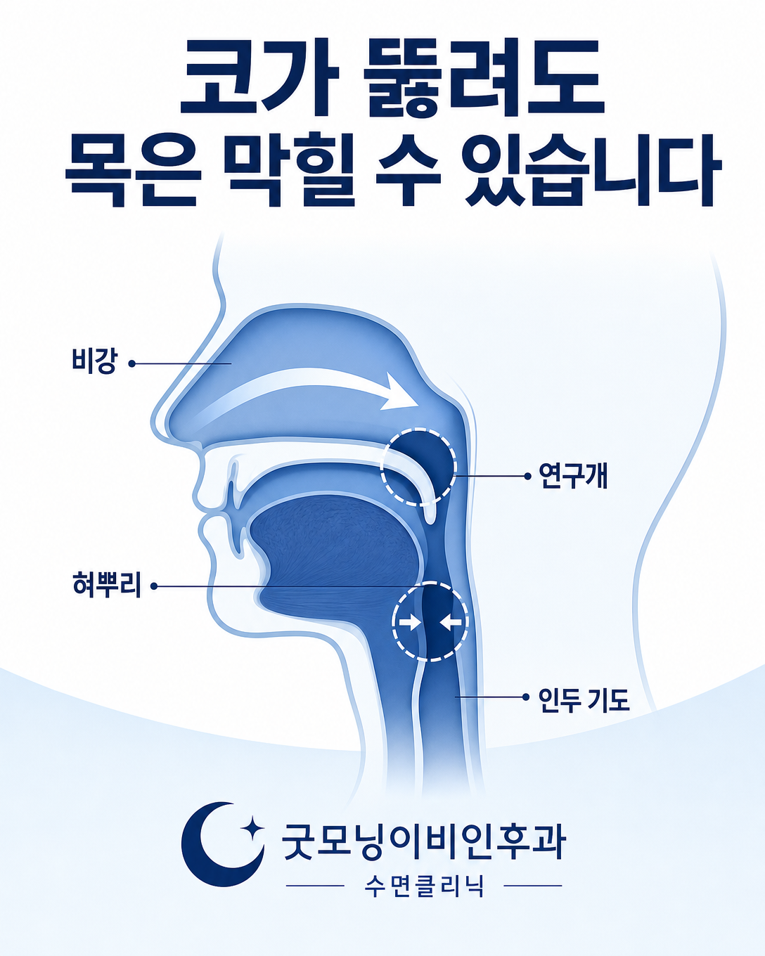 비강과 연구개·혀뿌리 등 수면 중 상기도 폐쇄 위치를 구분한 해부학 도식
