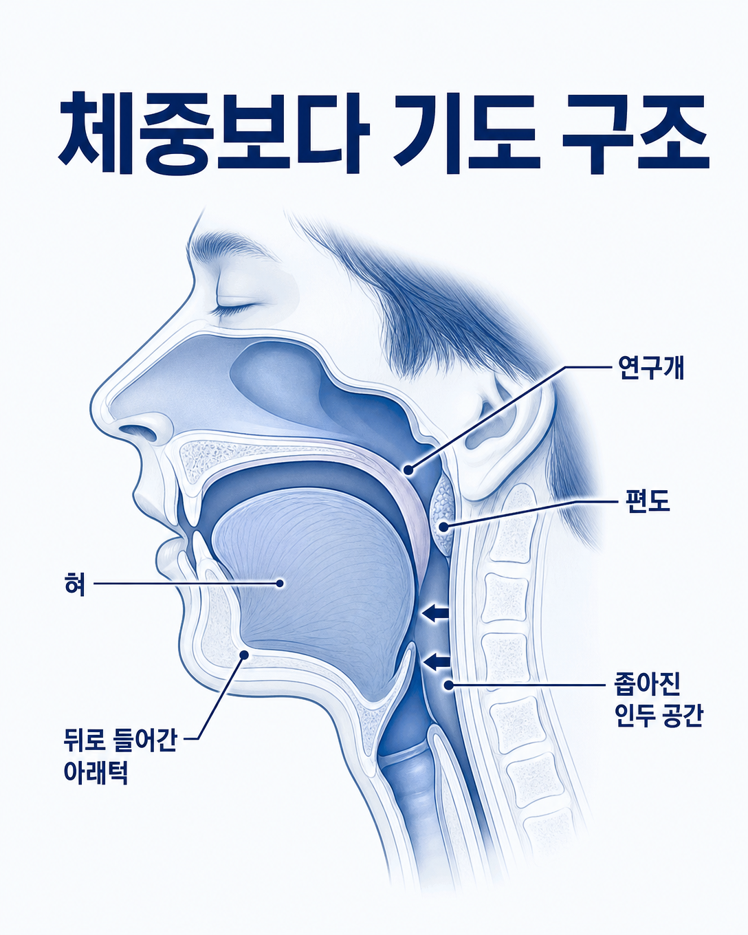 작거나 뒤로 들어간 턱과 혀·연구개가 상기도 공간에 미치는 영향을 설명하는 해부 도식