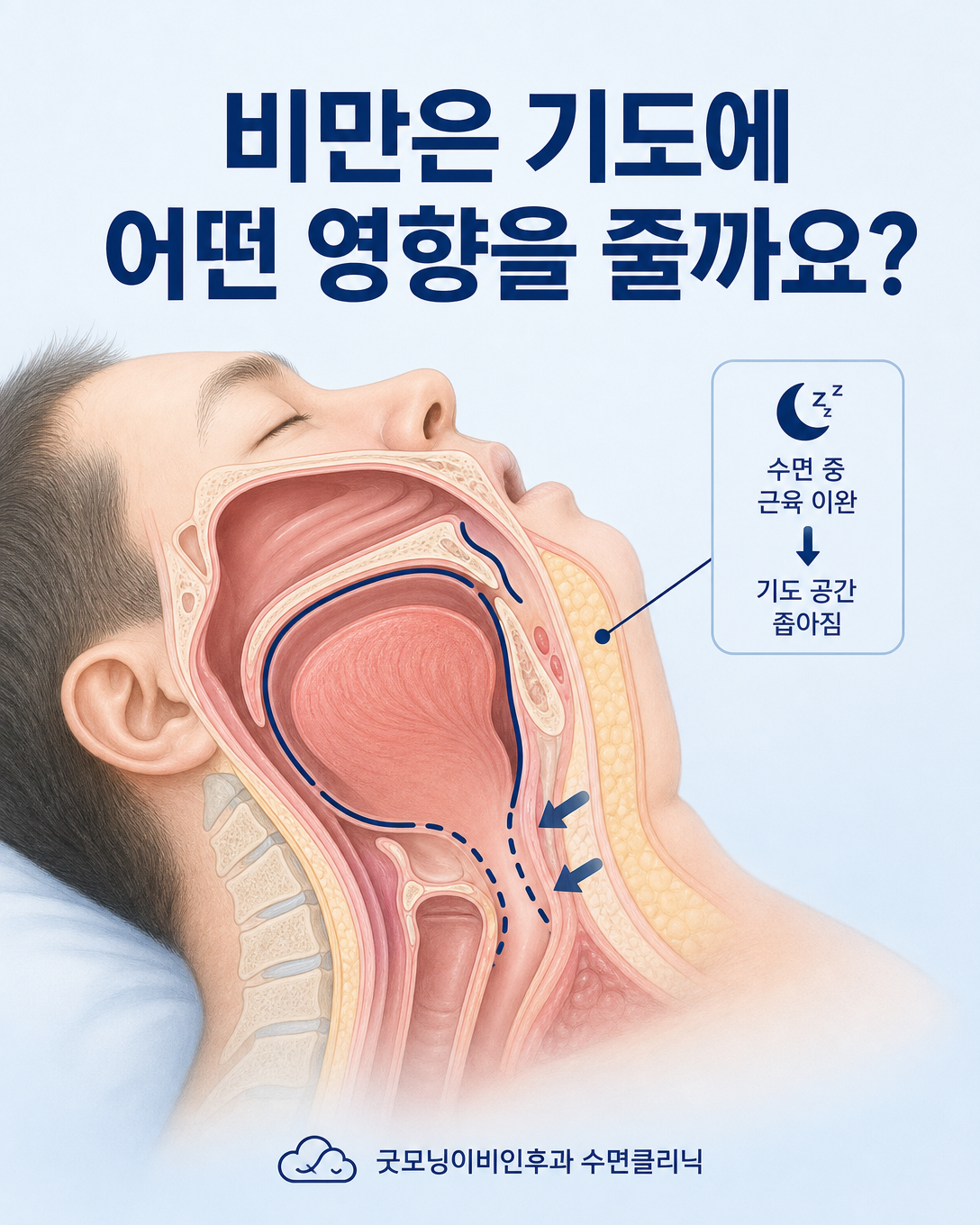 목 주변 연조직과 수면 중 상기도가 좁아지는 기전을 설명한 그림