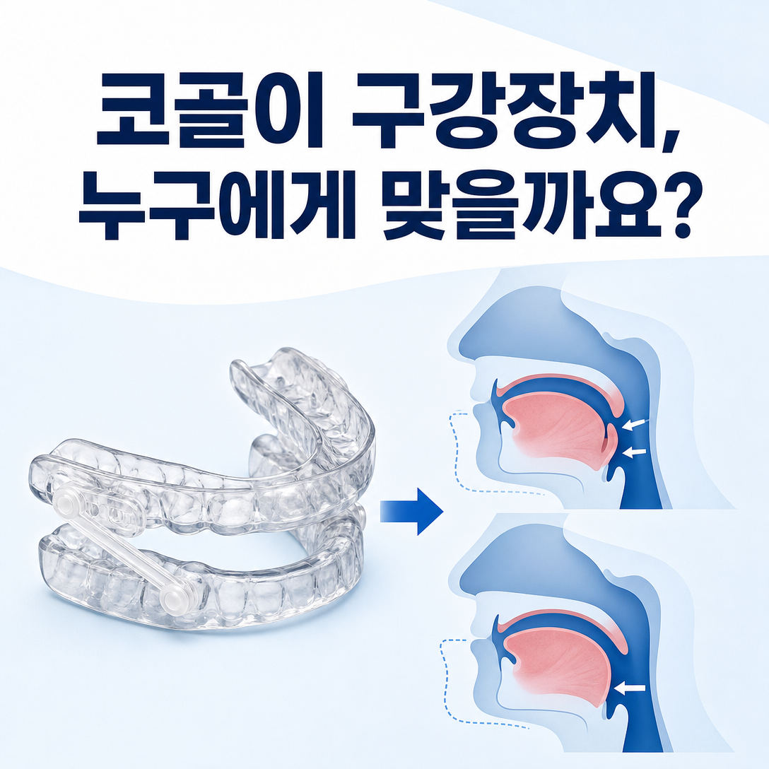 코골이 구강장치 대상과 효과 확인을 설명하는 맞춤형 하악전진장치 및 상기도 도식
