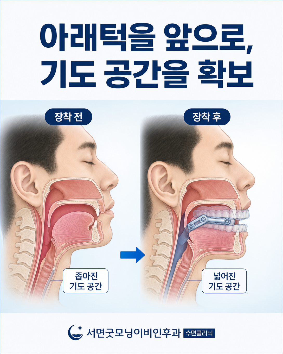 맞춤형 하악전진장치가 아래턱과 혀를 앞으로 유지해 상기도 공간 확보를 돕는 원리