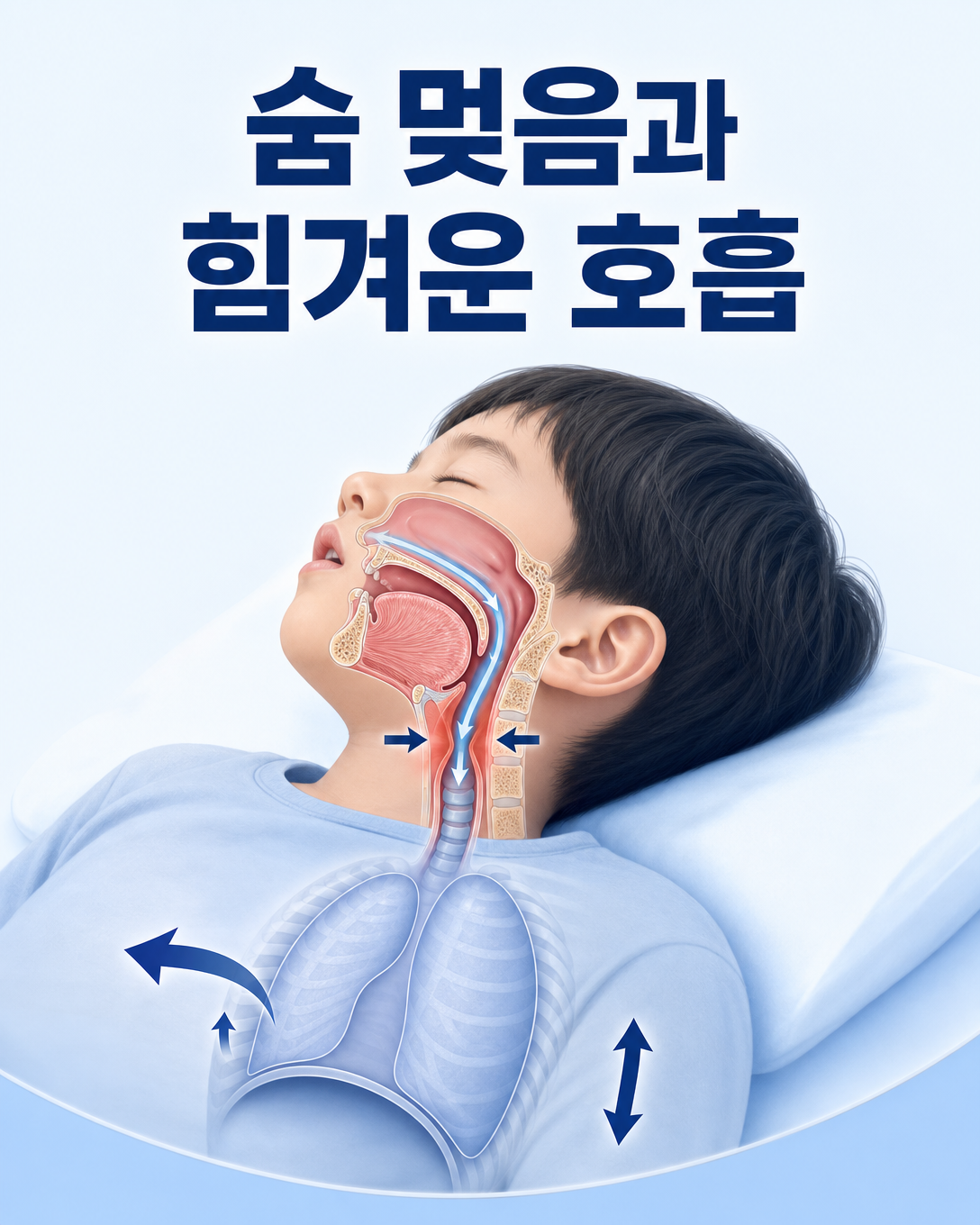 아이의 수면 중 숨 멎음과 힘겨운 호흡을 상기도 도식으로 설명하는 이미지