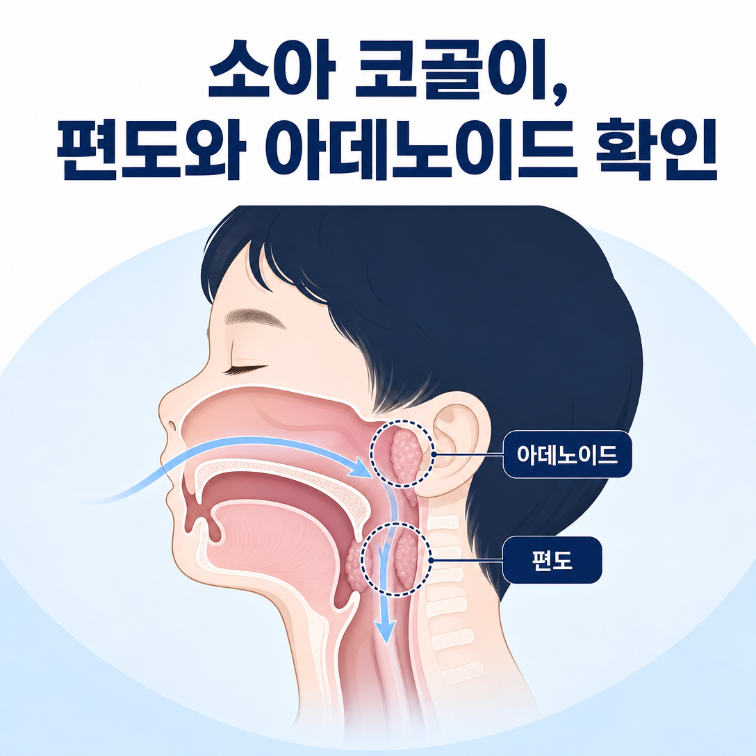 소아 코골이에서 편도와 아데노이드의 위치와 상기도 폐쇄 가능성을 보여주는 대표 이미지