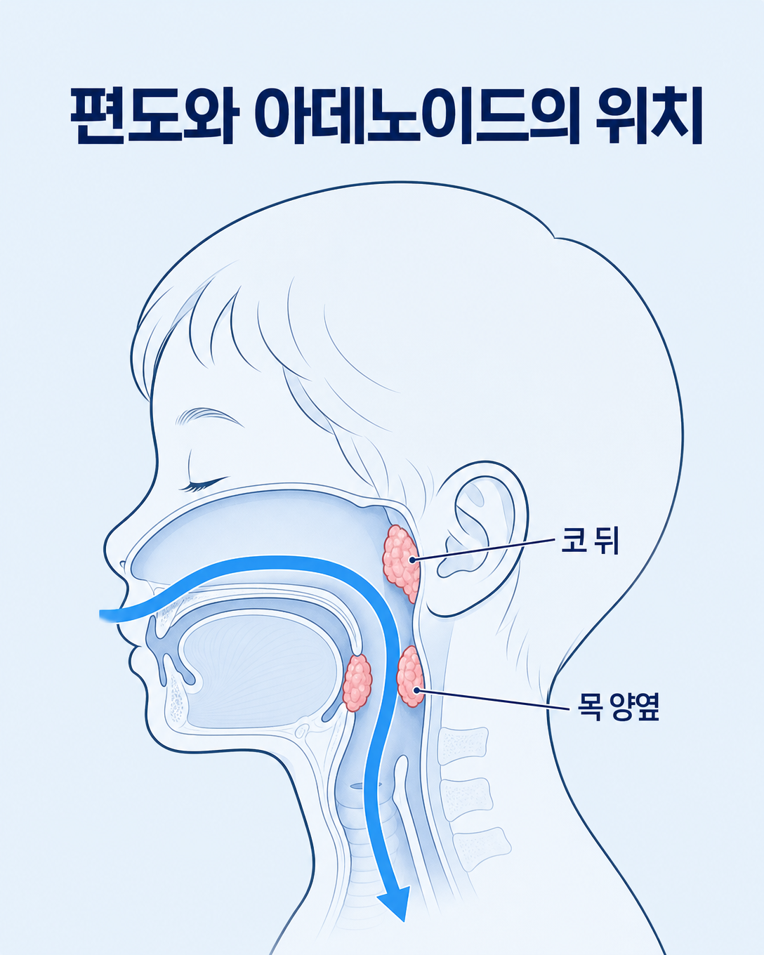어린이의 코 뒤 아데노이드와 목 양옆 편도 위치를 보여주는 상기도 해부도