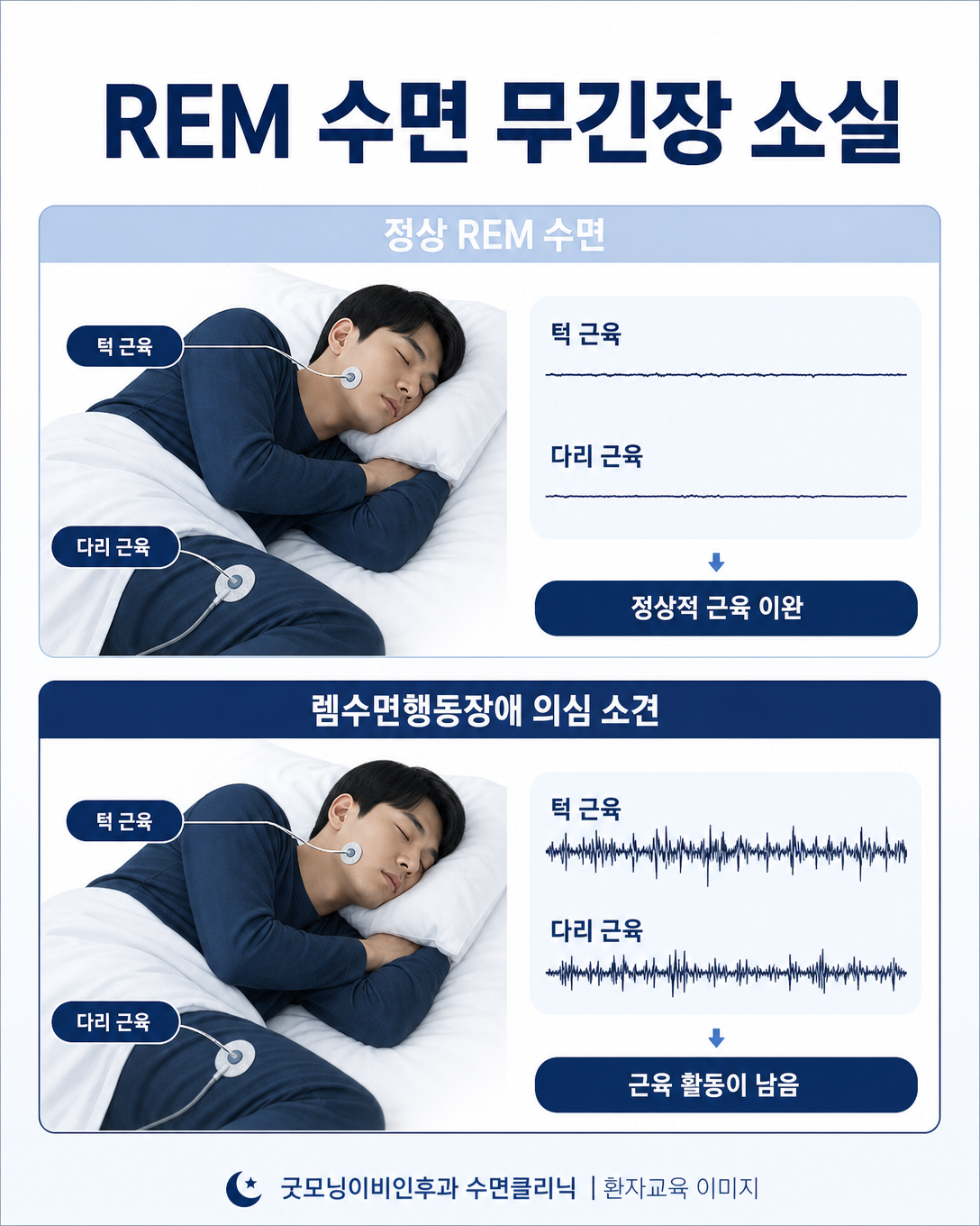 정상 REM 수면의 근육 이완과 REM 수면 무긴장 소실을 비교한 교육 도식