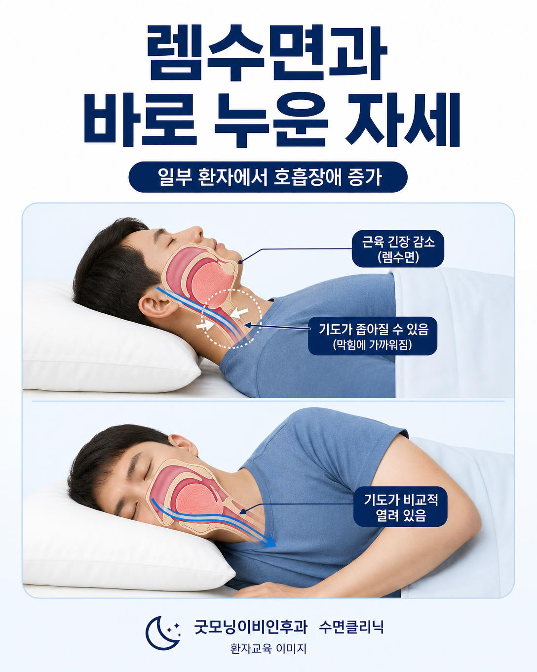 렘수면과 바로 누운 자세에서 일부 환자의 상기도가 더 좁아질 수 있음을 설명하는 이미지