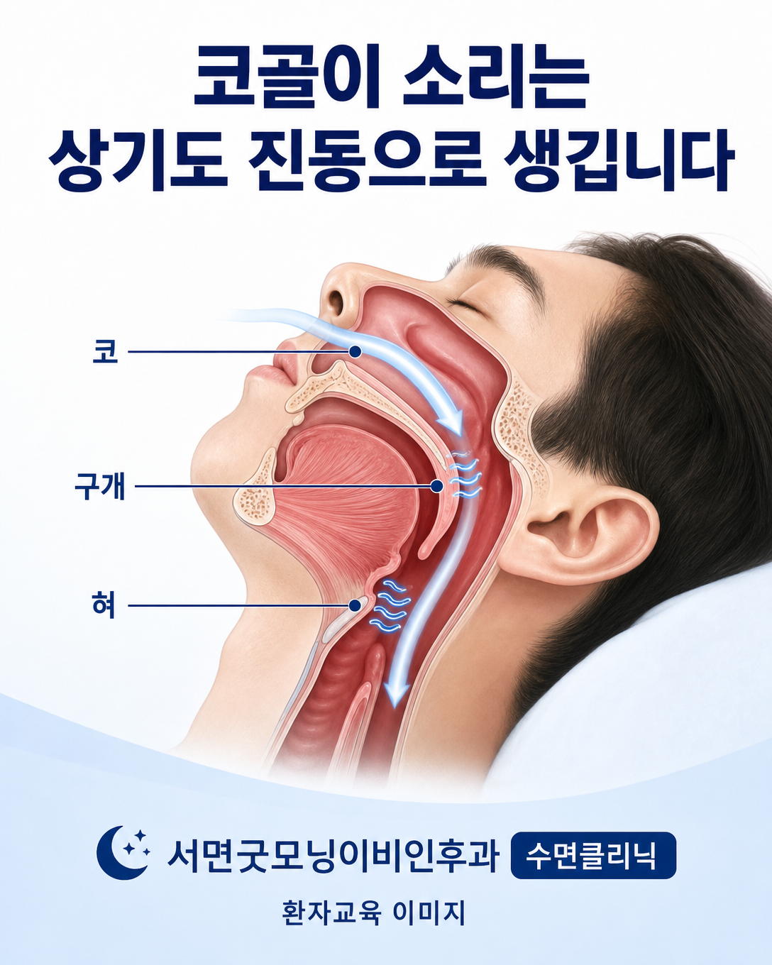 코와 연구개, 혀뿌리 주변 상기도 조직의 진동으로 코골이 소리가 발생하는 과정을 설명한 그림
