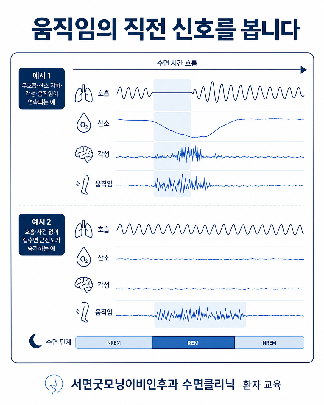 호흡 사건 직후 움직임과 렘수면 근긴장 증가를 시간축에서 비교한 검사 해석 도식