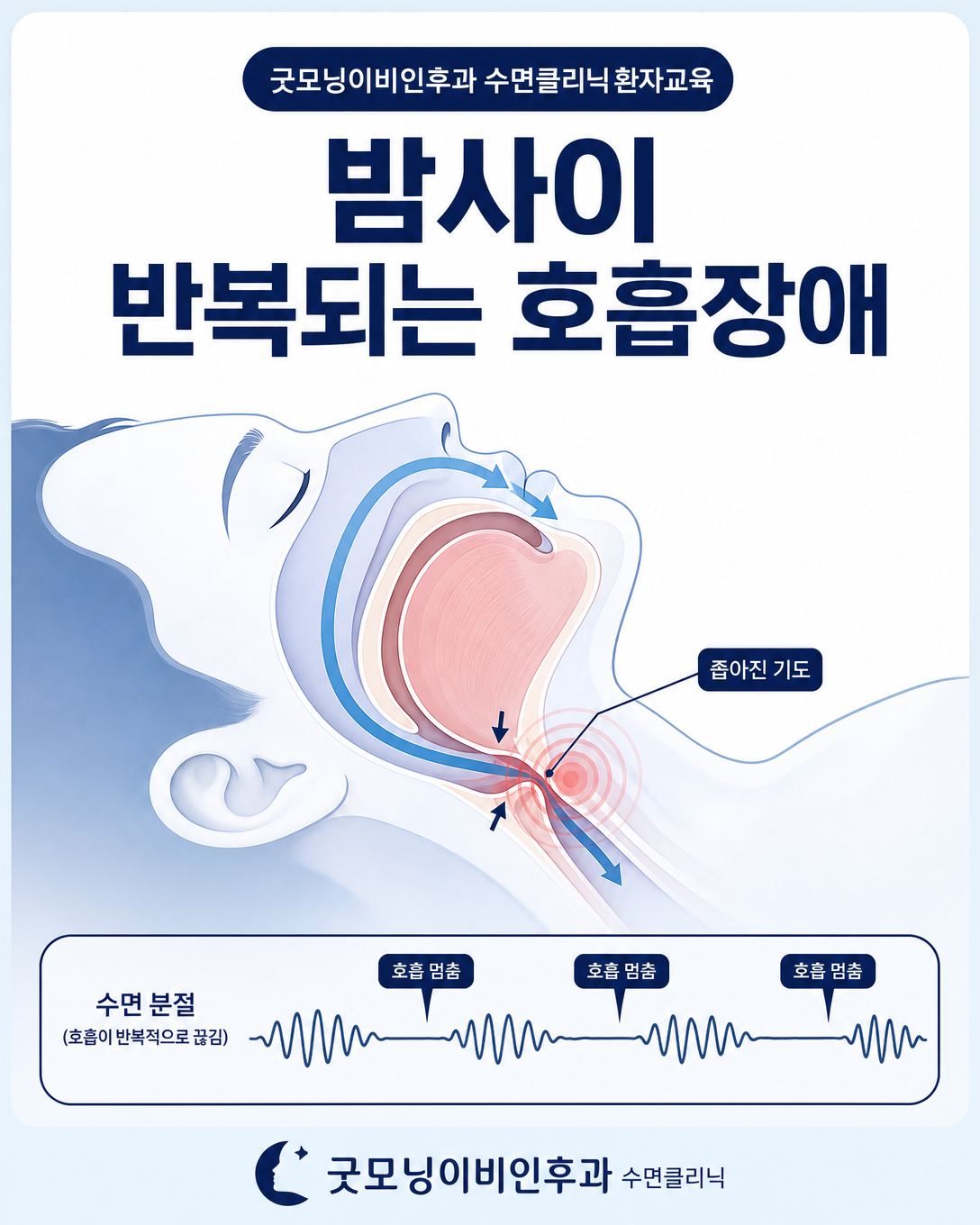 수면 중 상기도가 좁아지며 반복되는 호흡장애와 수면 분절을 설명하는 그림