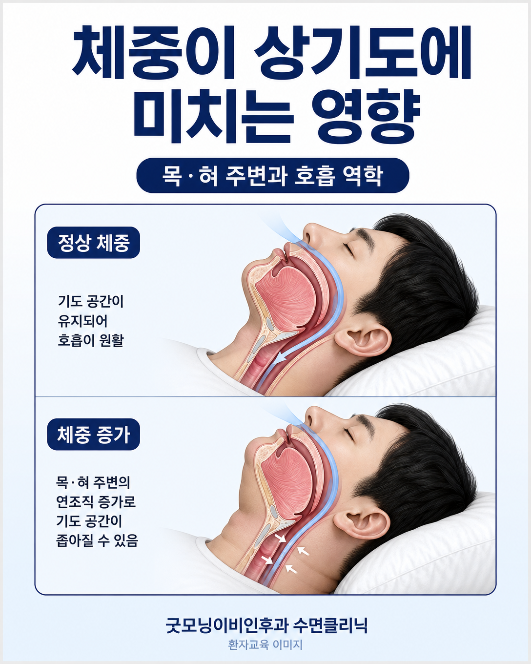 목과 혀 주변 지방 및 호흡 역학이 상기도에 미치는 영향을 설명한 그림