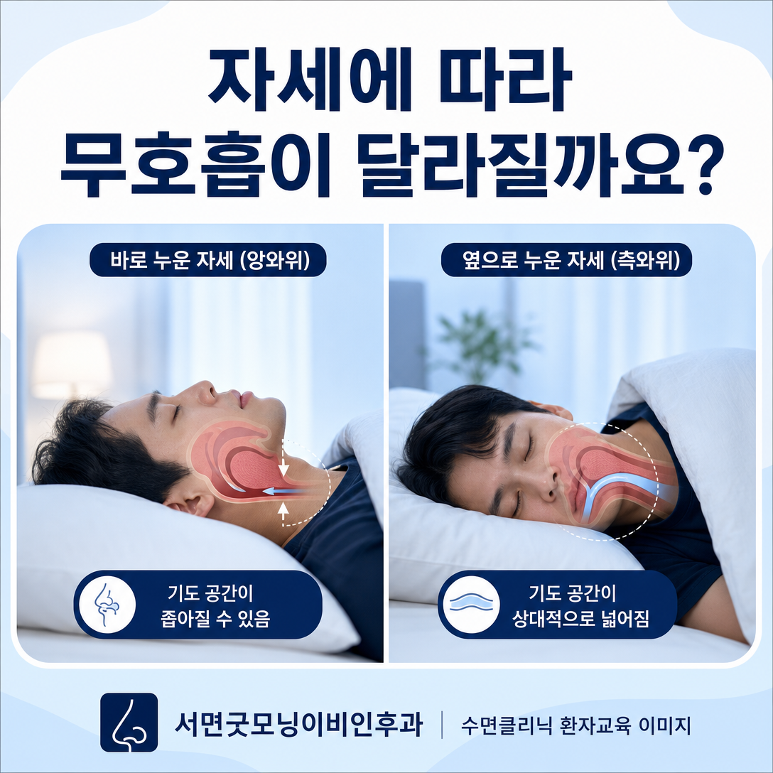 바로 누운 자세와 옆으로 누운 자세에서 기도 공간이 달라질 수 있음을 보여주는 수면무호흡 교육 이미지