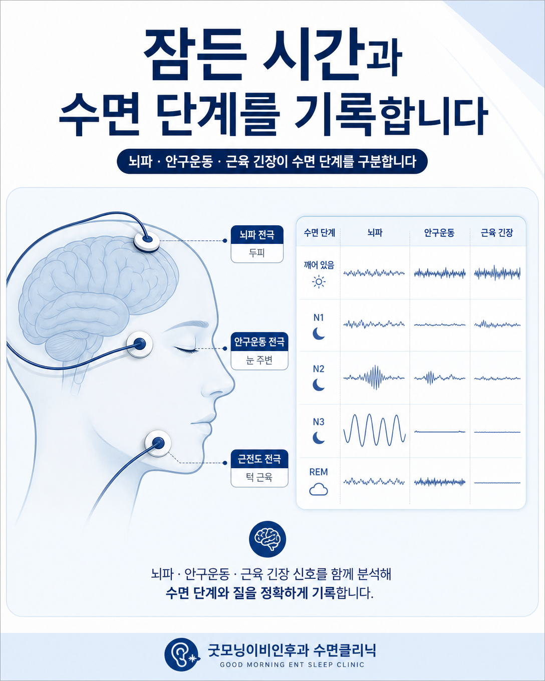 뇌파와 안구운동, 턱 근전도로 수면 단계와 각성을 기록하는 원리