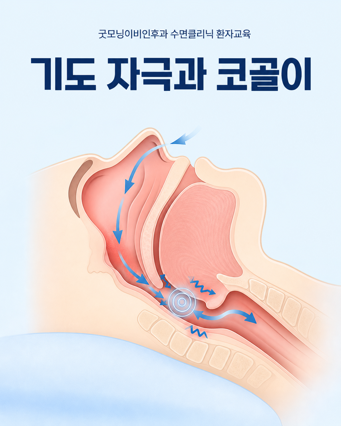 담배 연기와 에어로졸의 기도 자극이 코골이에 영향을 줄 수 있는 기전