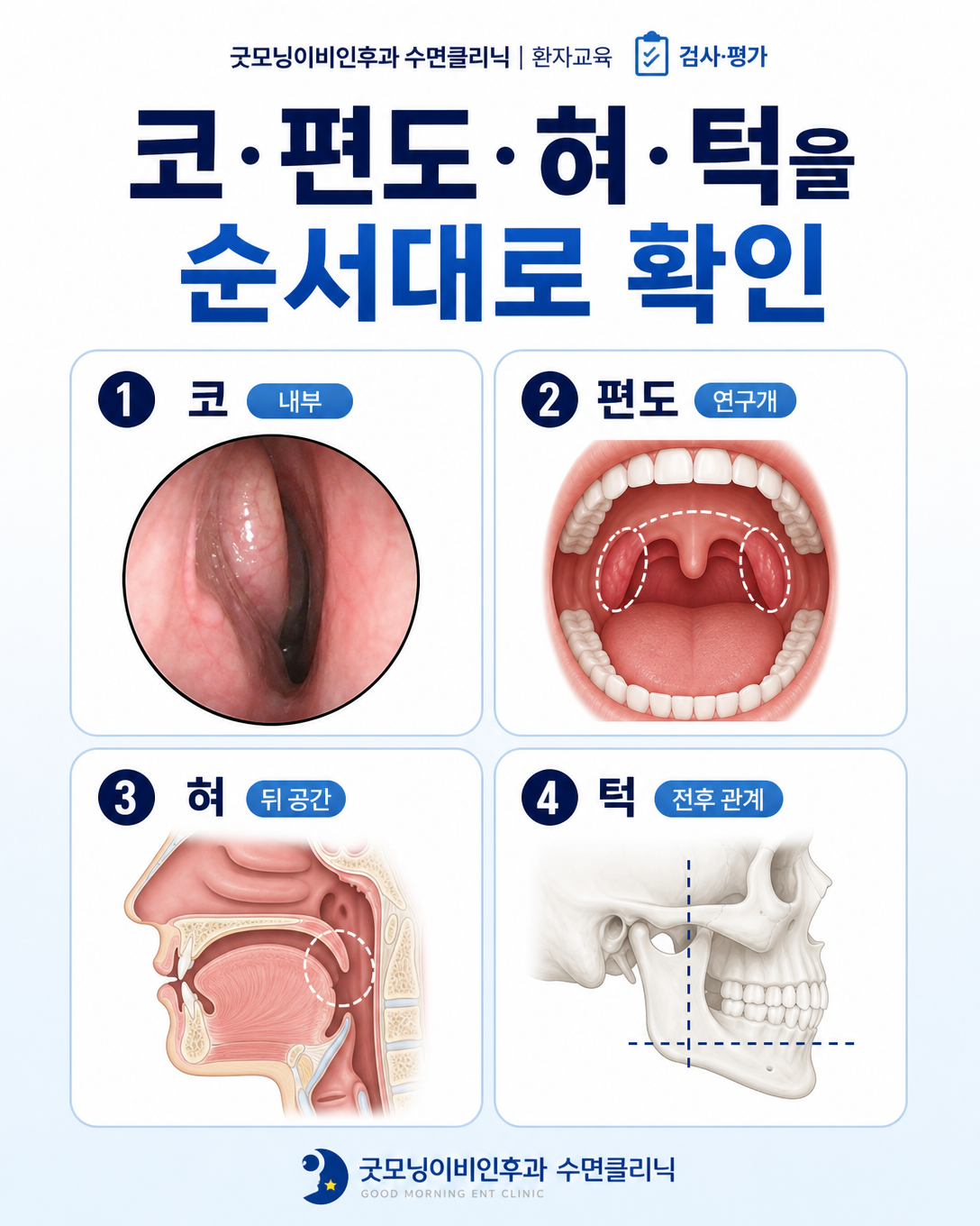 코, 편도, 혀, 턱을 순서대로 살피는 코골이 상기도 평가 항목