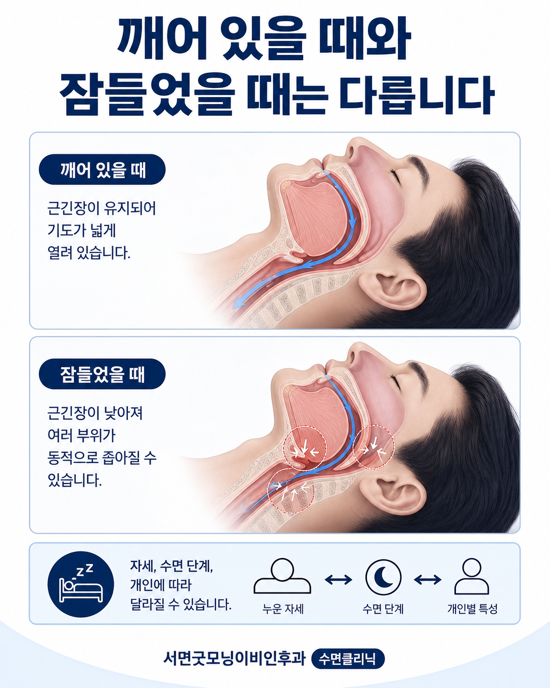 깨어 있을 때와 수면 중 상기도 근긴장과 공간이 달라질 수 있음을 보여주는 비교 도식