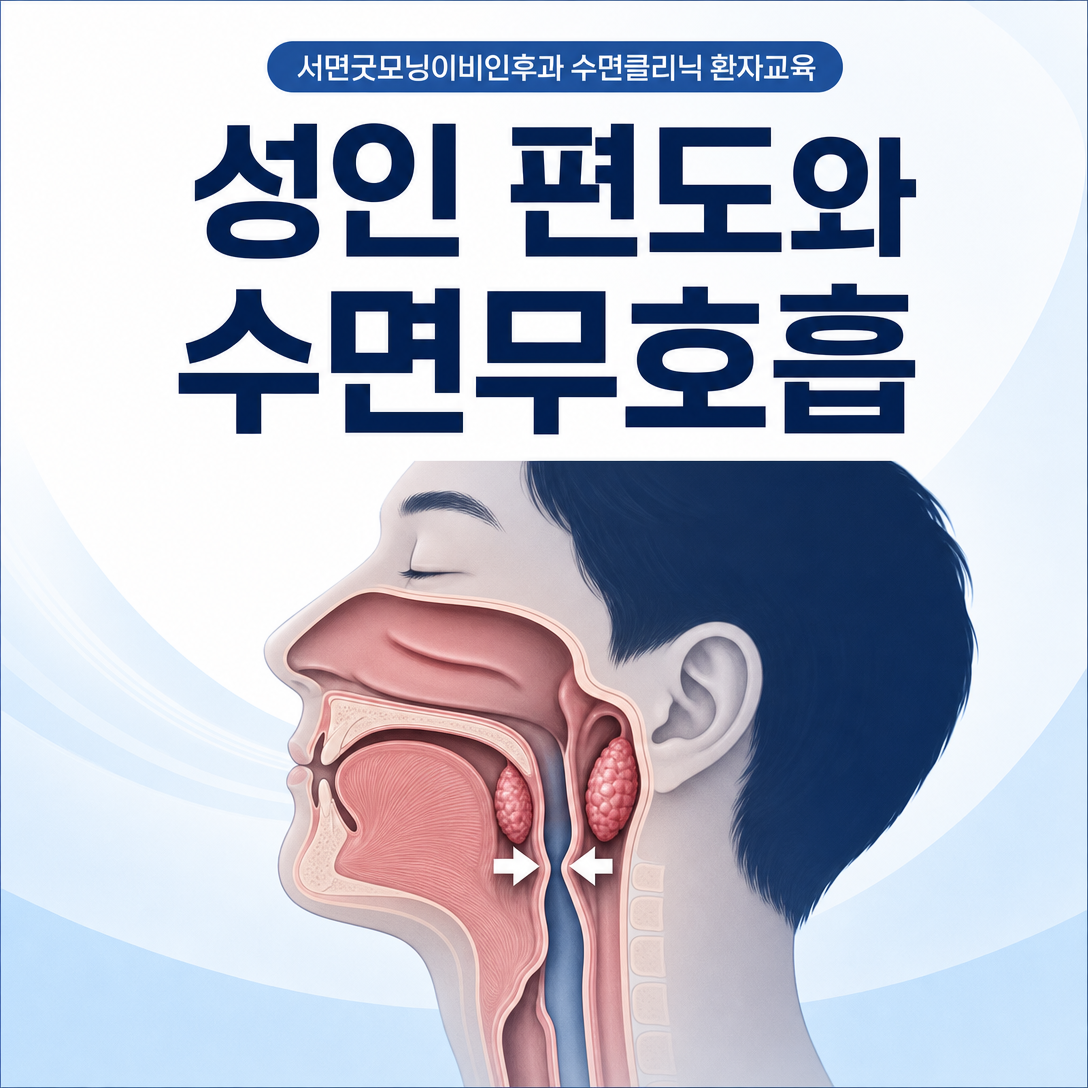 성인의 큰 편도와 코·연구개·혀 등 상기도 구조가 코골이와 수면무호흡에 미치는 영향을 보여주는 그림