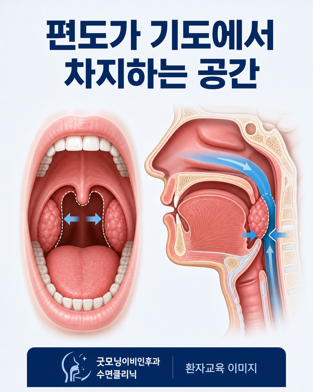 성인의 커진 구개편도가 목 안의 공기 통로에서 차지하는 공간을 설명하는 해부학 그림