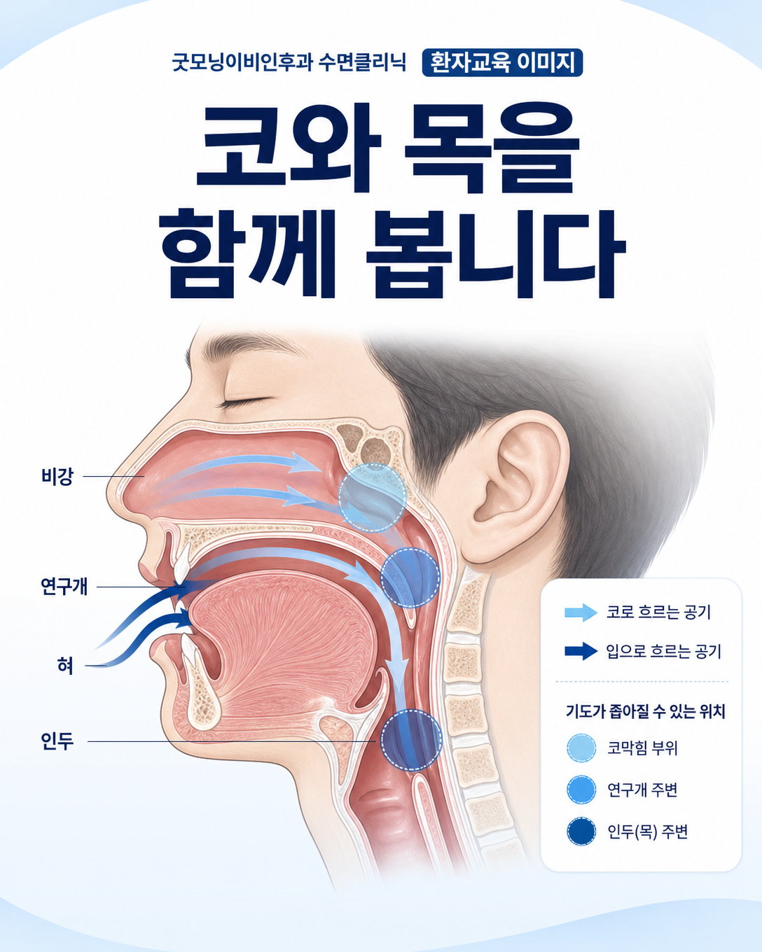 비강과 연구개, 혀, 인두를 통해 코막힘과 수면 중 기도 협착의 관계를 보여주는 상기도 도식