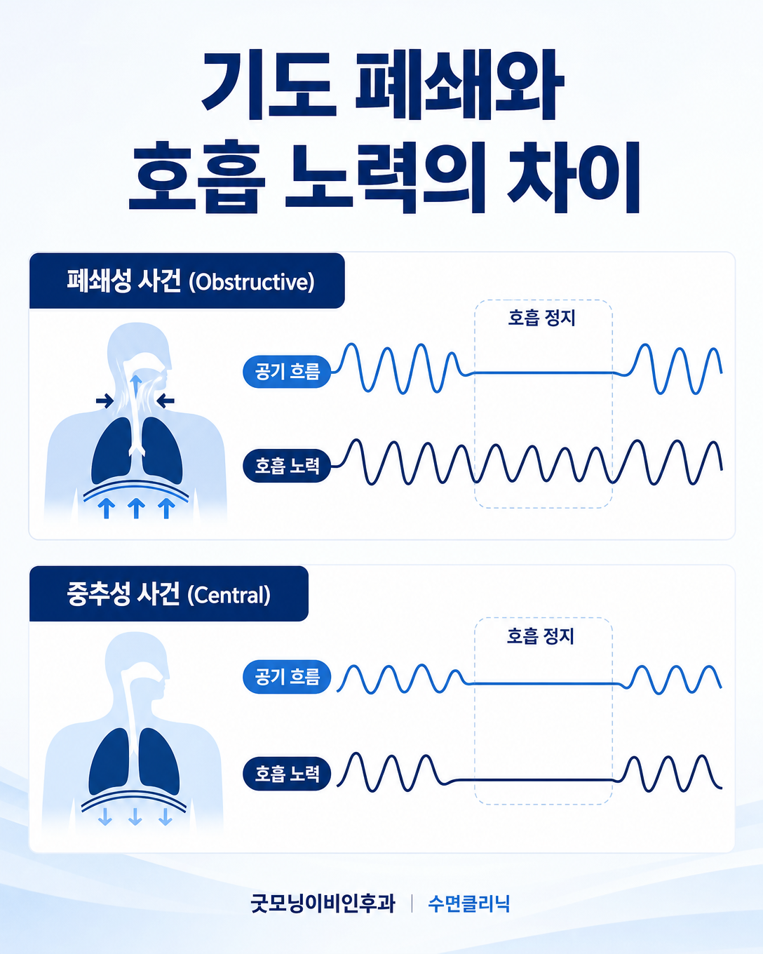 폐쇄성 무호흡과 중추성 무호흡의 호흡 노력 차이를 설명한 도식