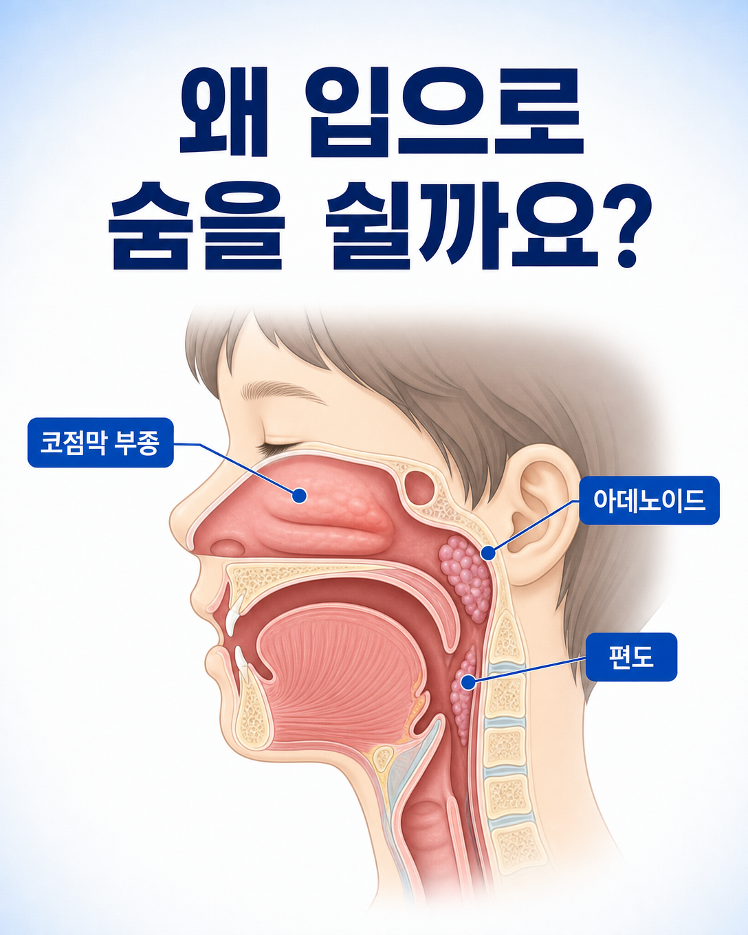 아이의 코막힘과 구강호흡에 영향을 줄 수 있는 코점막, 아데노이드와 편도 위치 도식