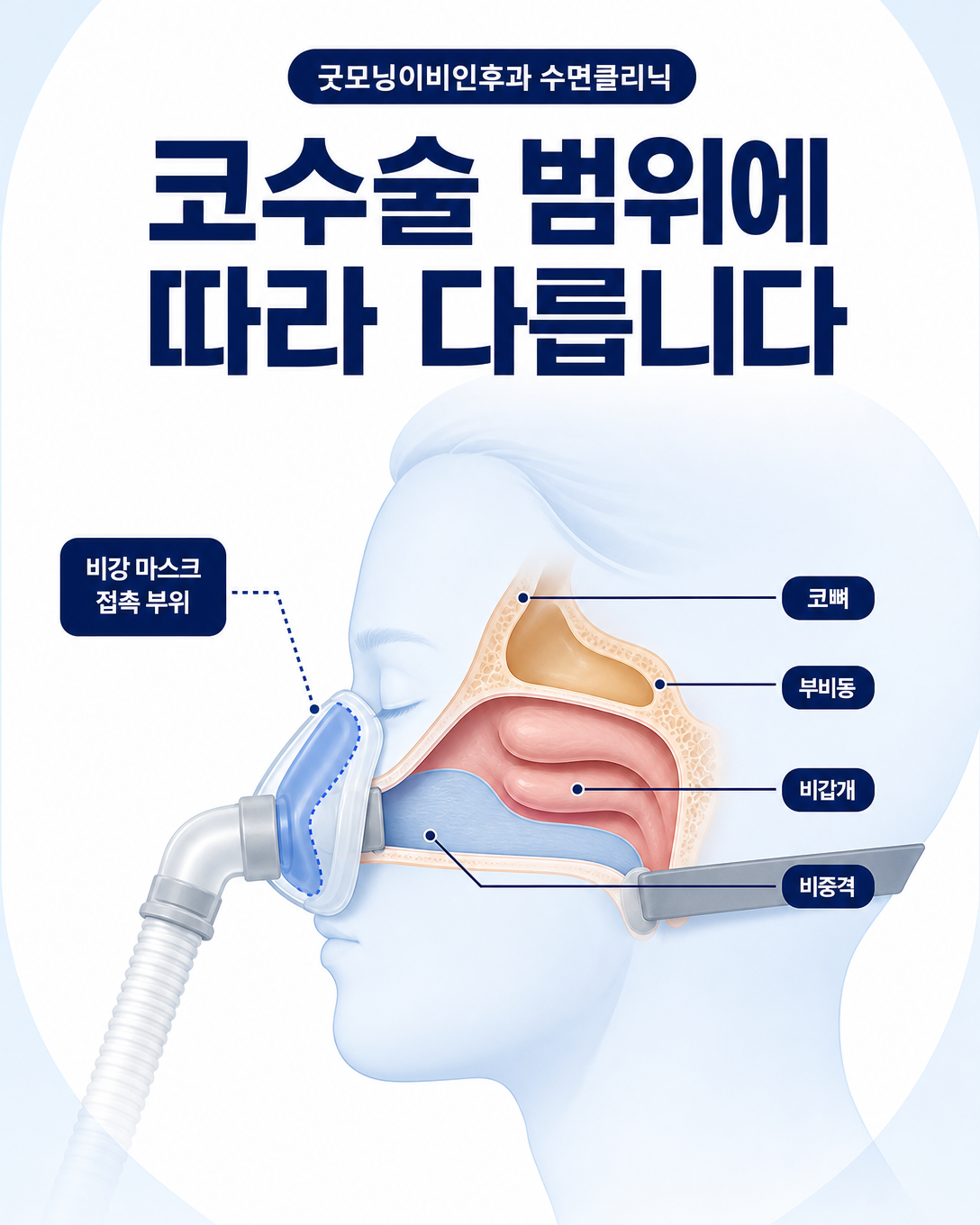 비중격과 코뼈, 부비동 수술 범위 및 양압기 마스크 접촉 부위 도식