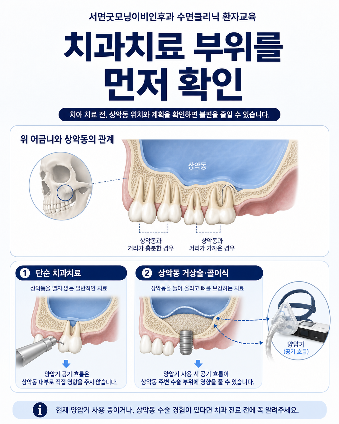 위 어금니와 상악동의 위치 및 치과수술 후 양압기 사용 주의점 도식