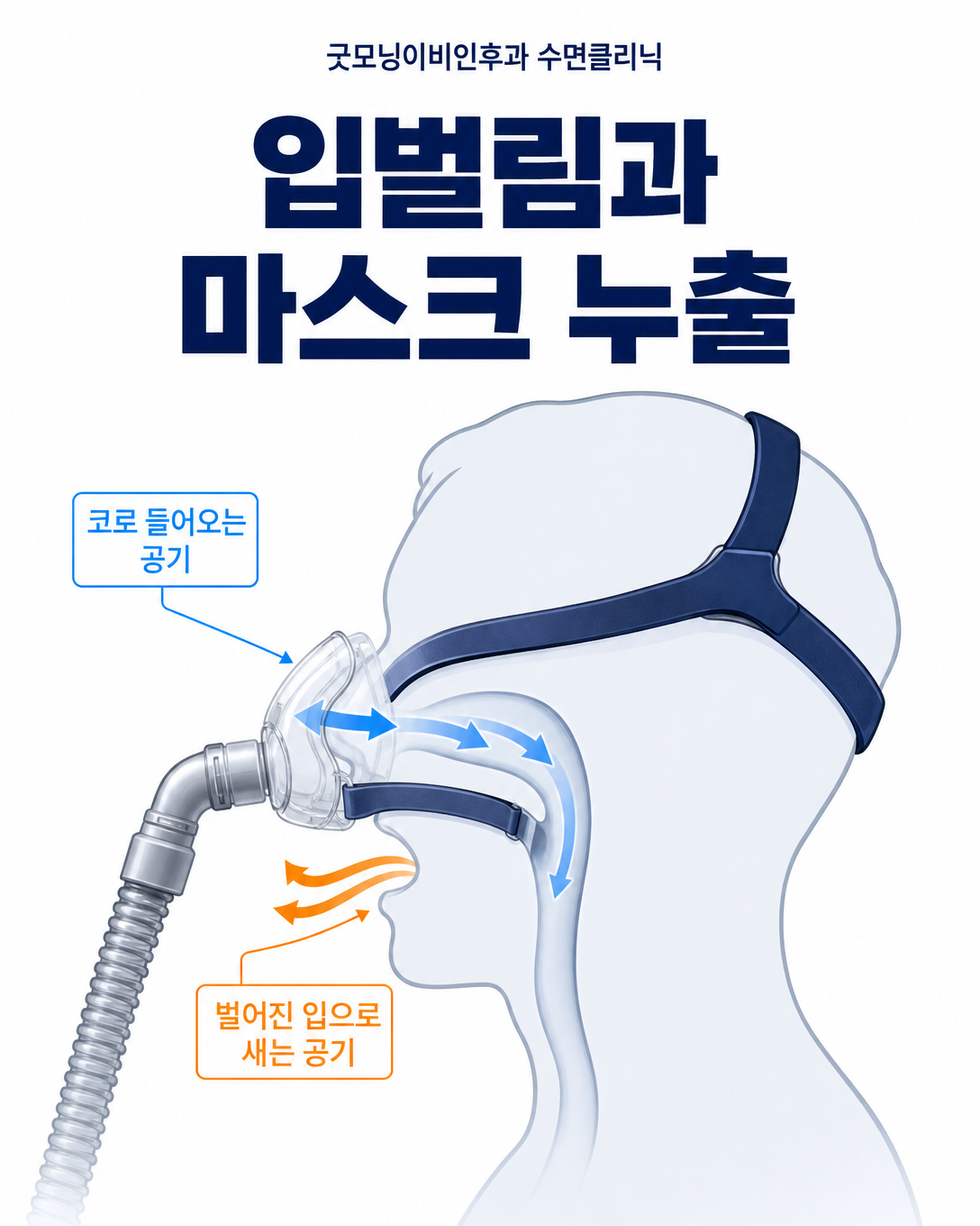 비강형 양압기 사용 중 입벌림으로 공기가 새는 과정을 설명한 도식