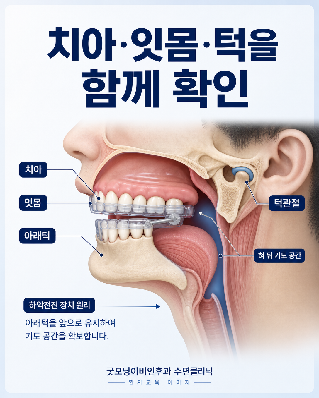 구강장치 치료 전 치아와 잇몸, 아래턱 및 혀 뒤 기도 공간을 평가하는 도식