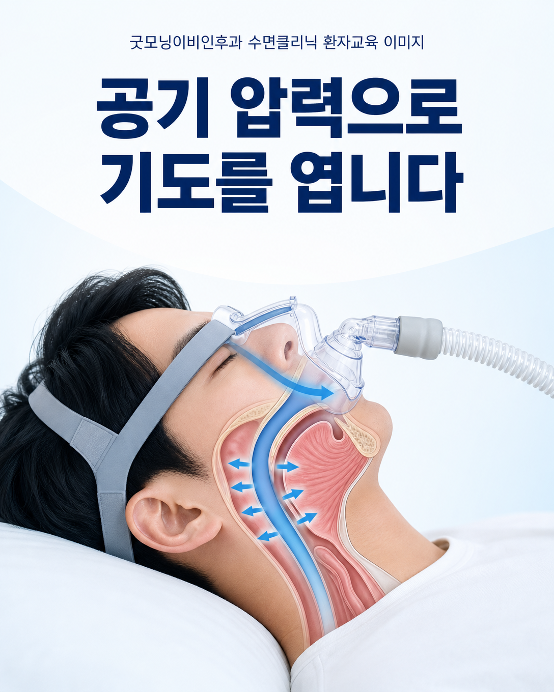 양압기 공기 압력이 수면 중 좁아지는 상기도를 지지하는 치료 원리 도식