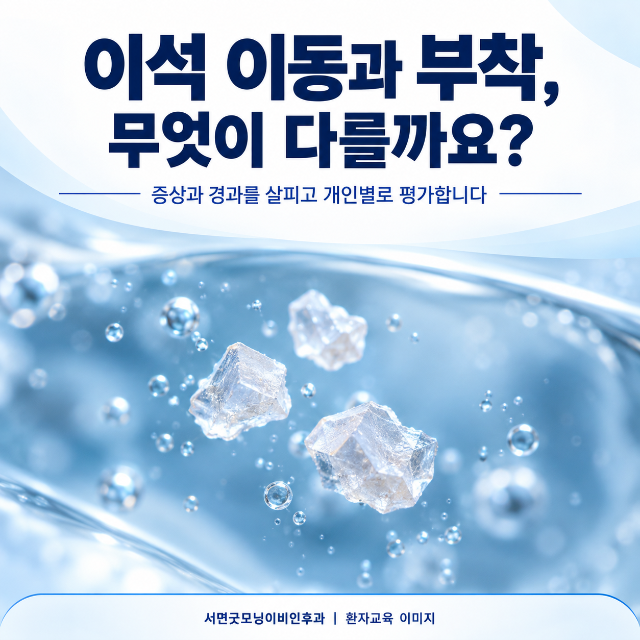 이석 결정의 이해를 돕는 개념 그림