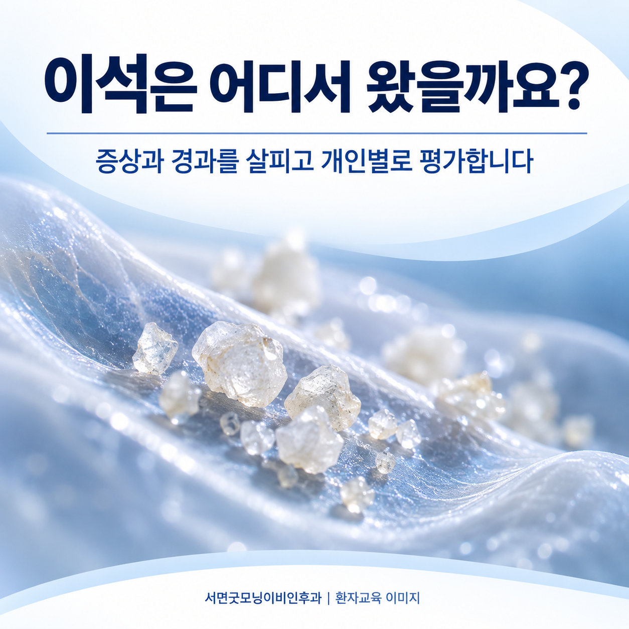 이석 결정의 이해를 돕는 개념 그림