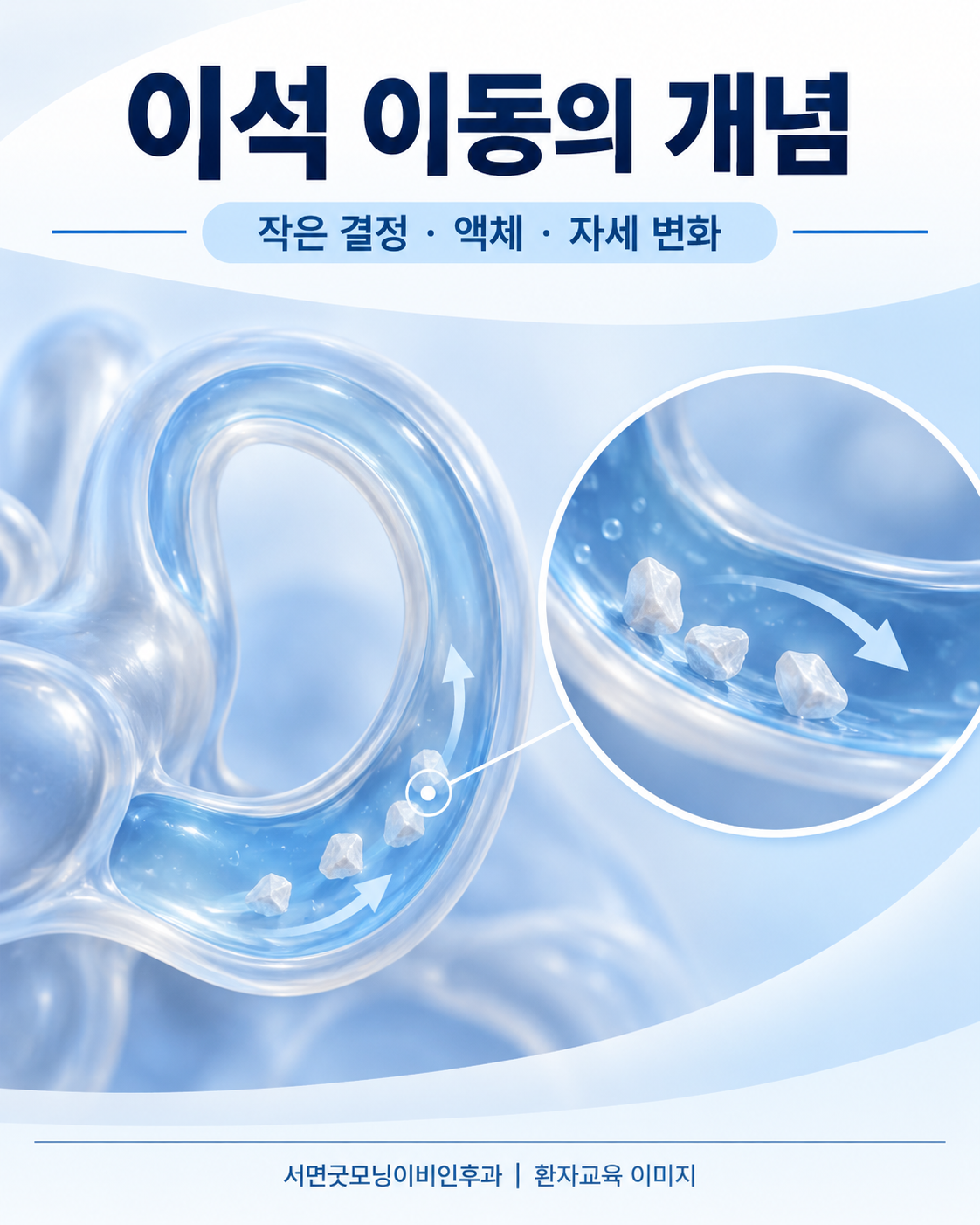 액체가 든 곡선 통로와 작은 결정으로 이석 이동 개념을 설명한 그림
