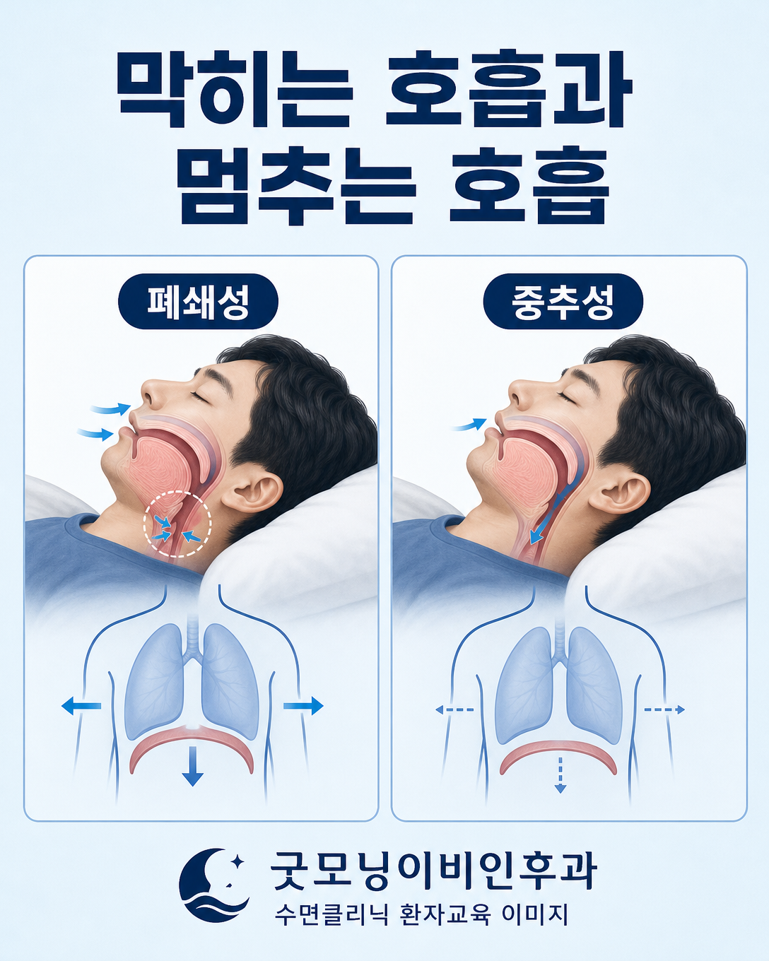 폐쇄성 수면무호흡과 중추성 수면무호흡의 호흡 노력 차이를 설명하는 그림