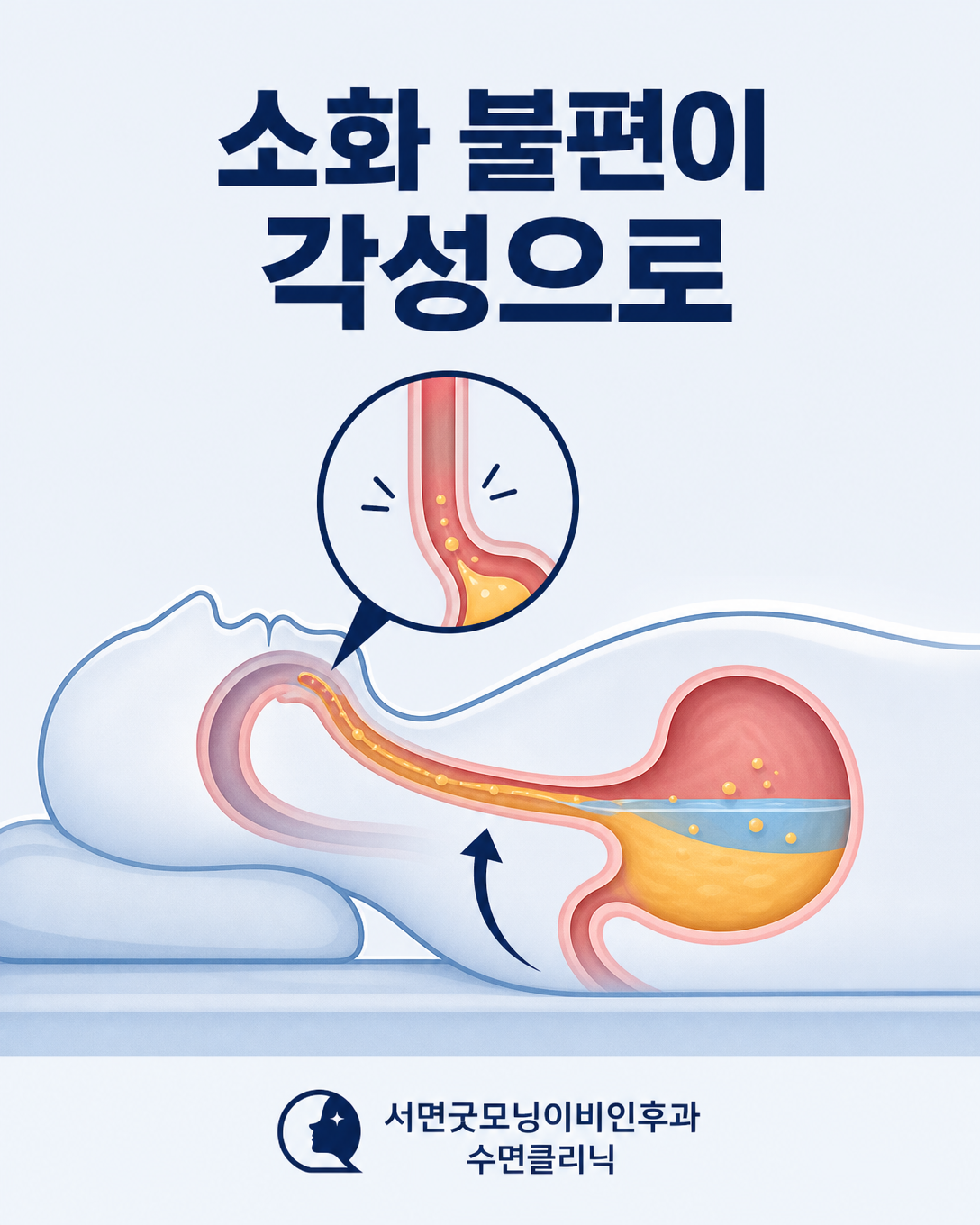 식후 역류와 소화 불편이 수면 각성으로 이어지는 과정을 나타낸 도식
