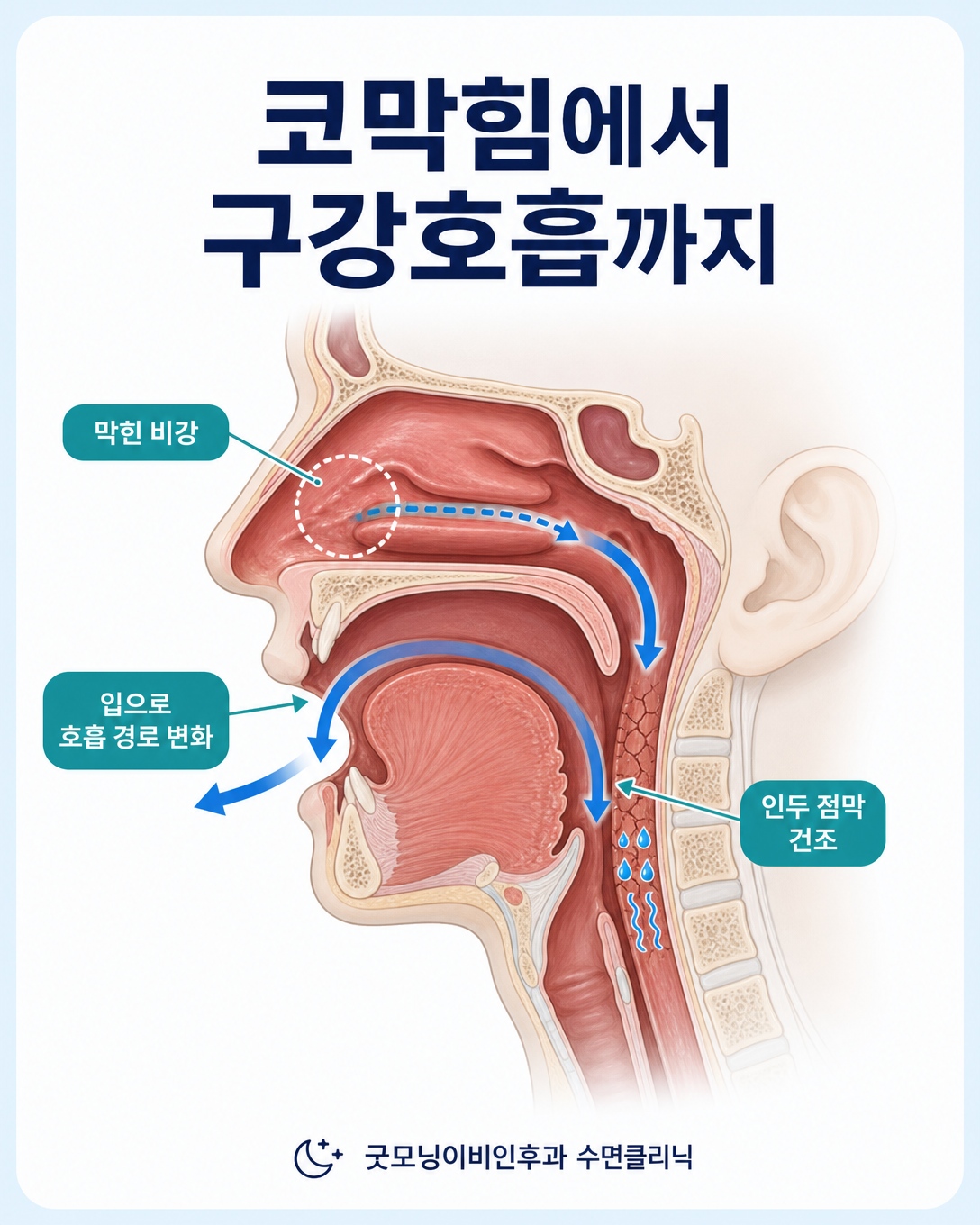코막힘으로 구강호흡이 생기고 목이 건조해지는 과정을 설명한 상기도 도식