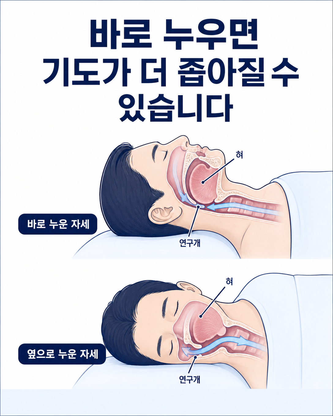 바로 누운 자세와 옆으로 누운 자세에 따른 상기도 공간의 차이