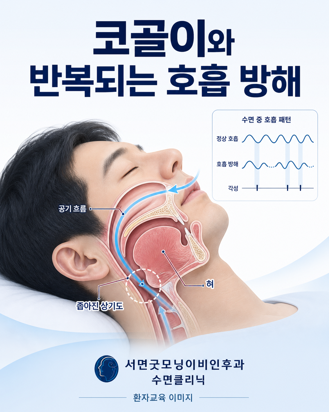 수면 중 상기도가 좁아져 코골이와 호흡 방해가 발생하는 과정을 보여주는 교육 도식