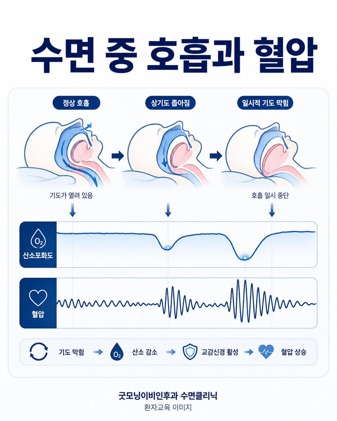 수면 중 기도 폐쇄와 산소 및 혈압 변화의 관련성을 설명하는 도식