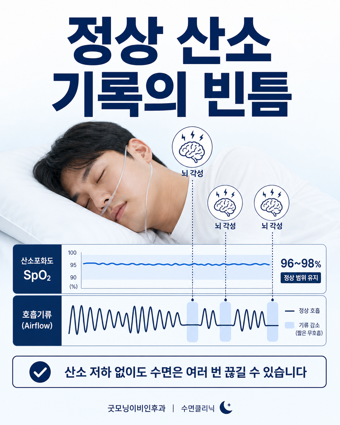 정상적인 산소 기록 사이에도 짧은 호흡 제한과 수면 각성이 생길 수 있음을 보여주는 그림