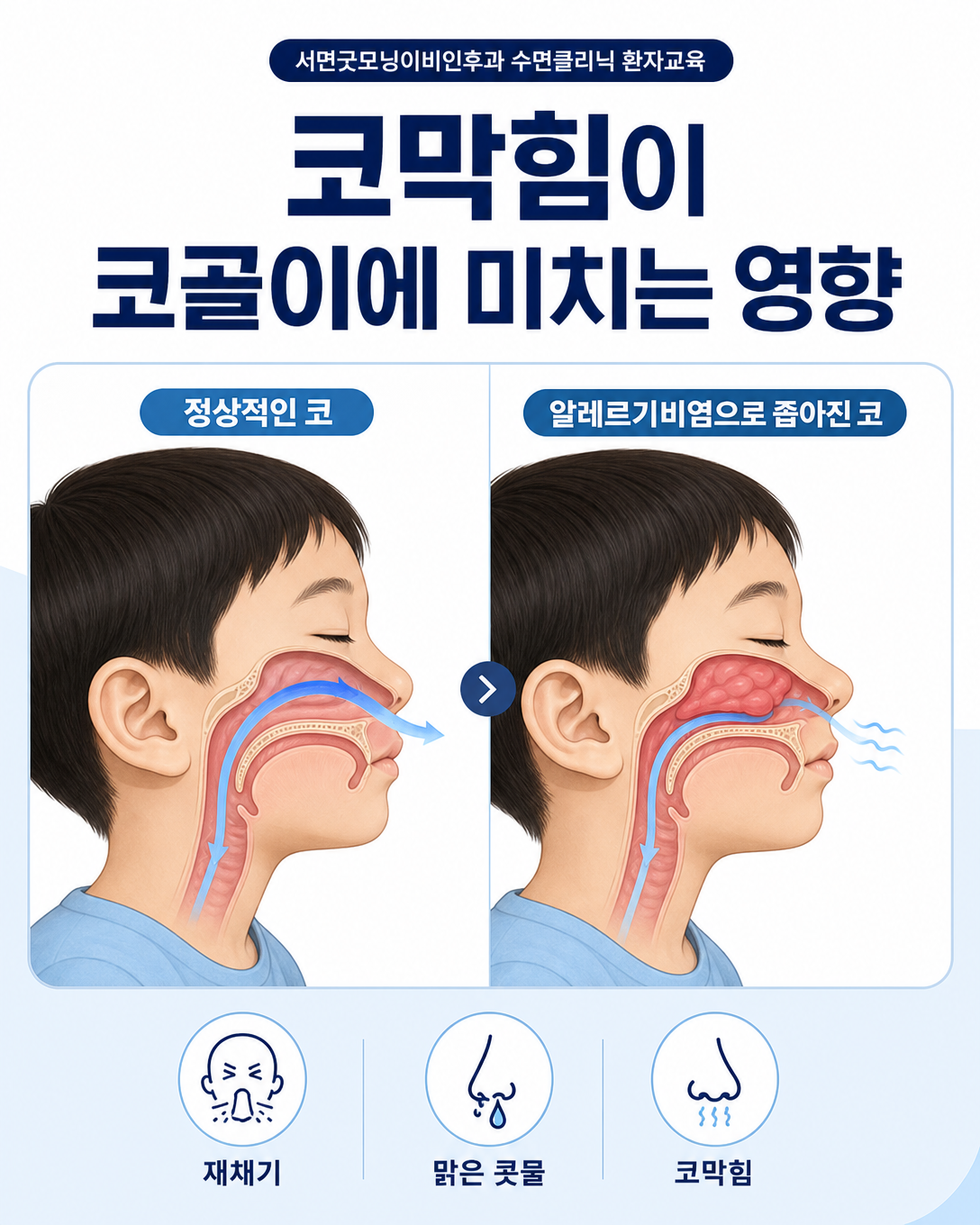 알레르기비염으로 좁아진 코의 공기 흐름과 정상 코 호흡을 비교한 그림