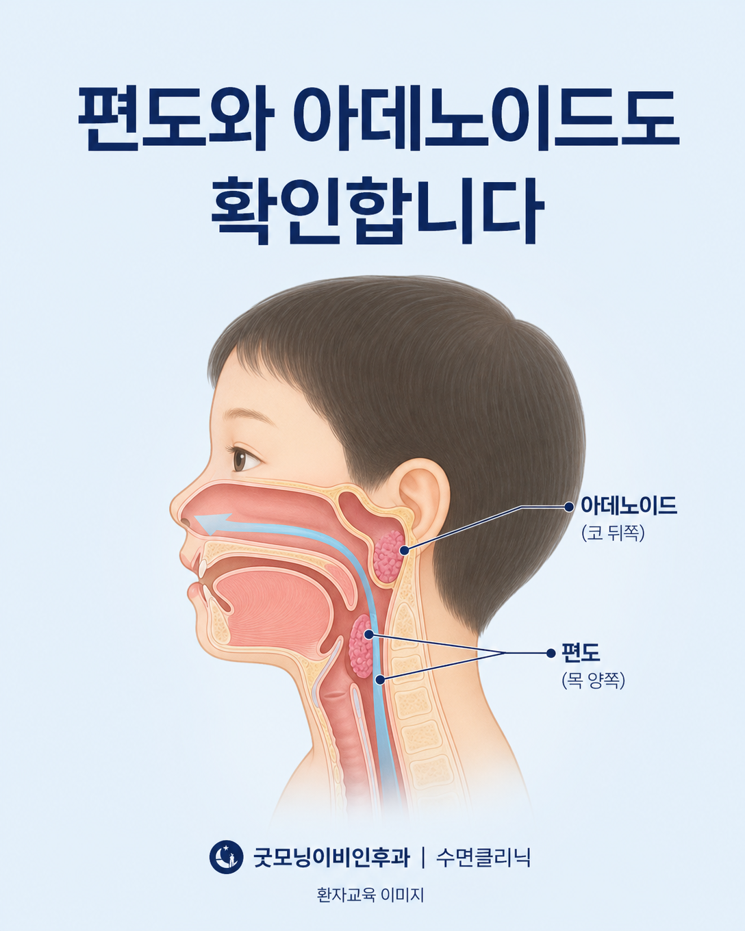 소아 코골이 원인이 될 수 있는 편도와 아데노이드의 위치를 보여주는 상기도 도식