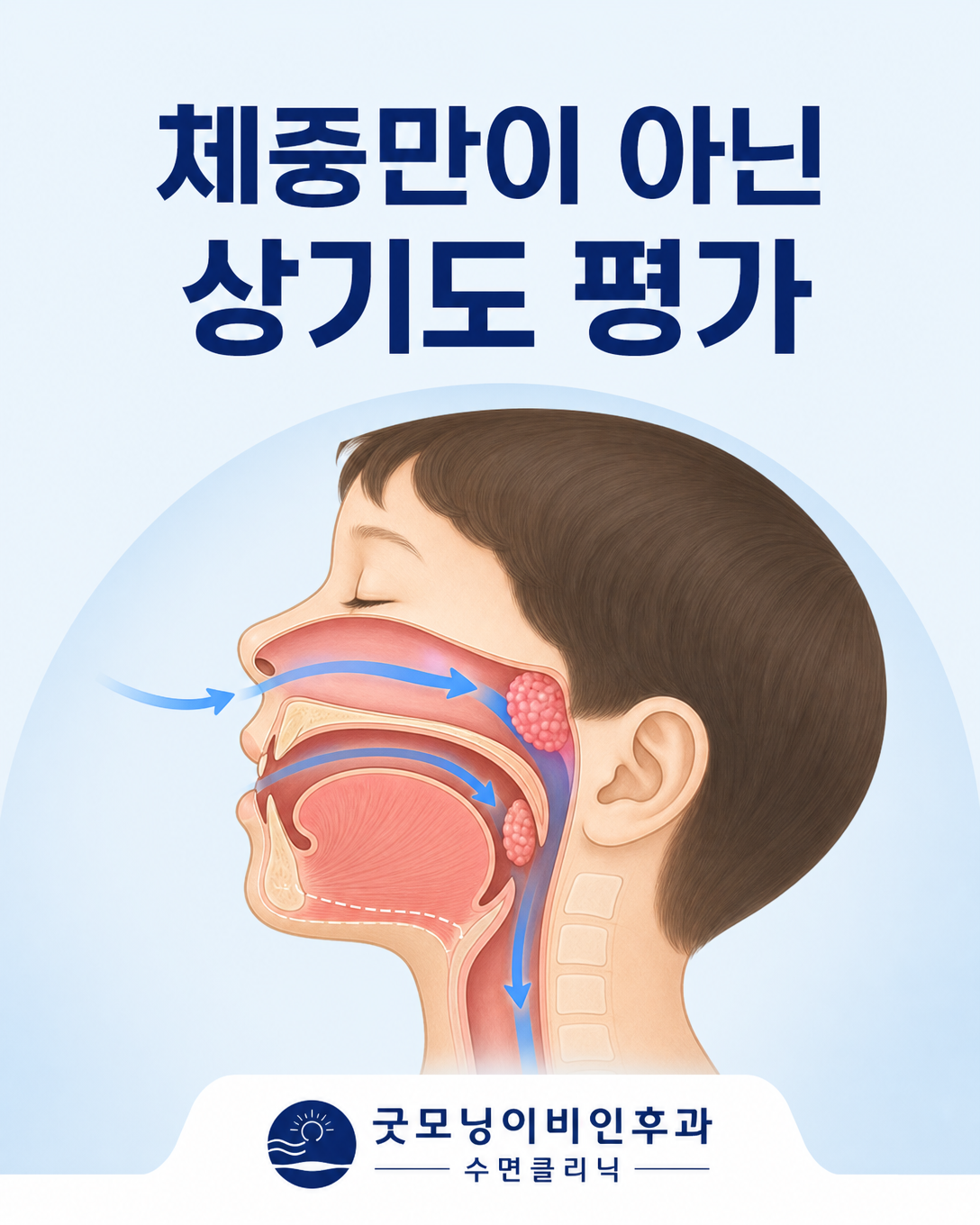 아이의 코와 아데노이드, 편도, 혀와 턱을 보여주는 상기도 평가 도식