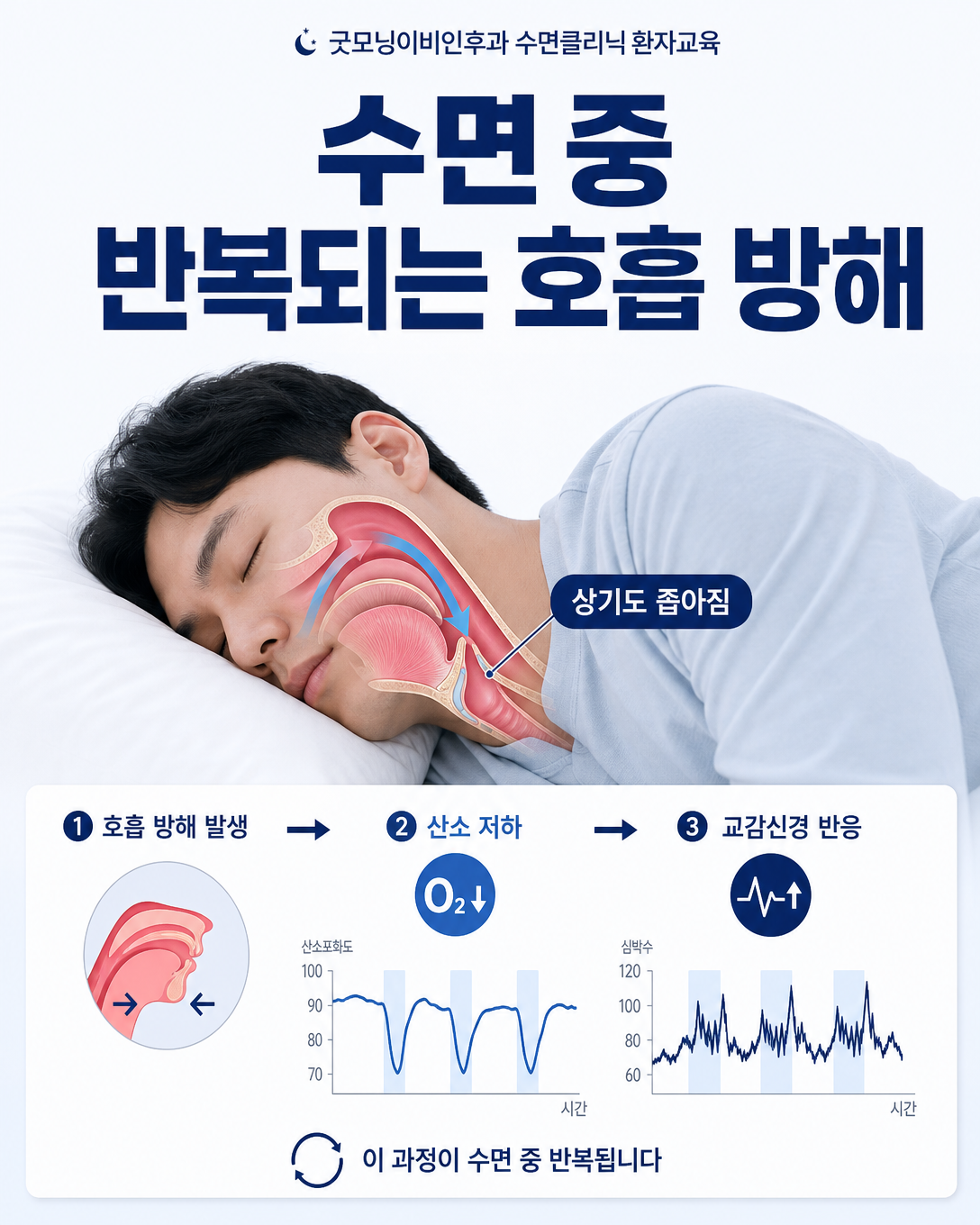 수면 중 상기도가 좁아져 산소 저하와 혈압 반응이 나타나는 수면무호흡 기전