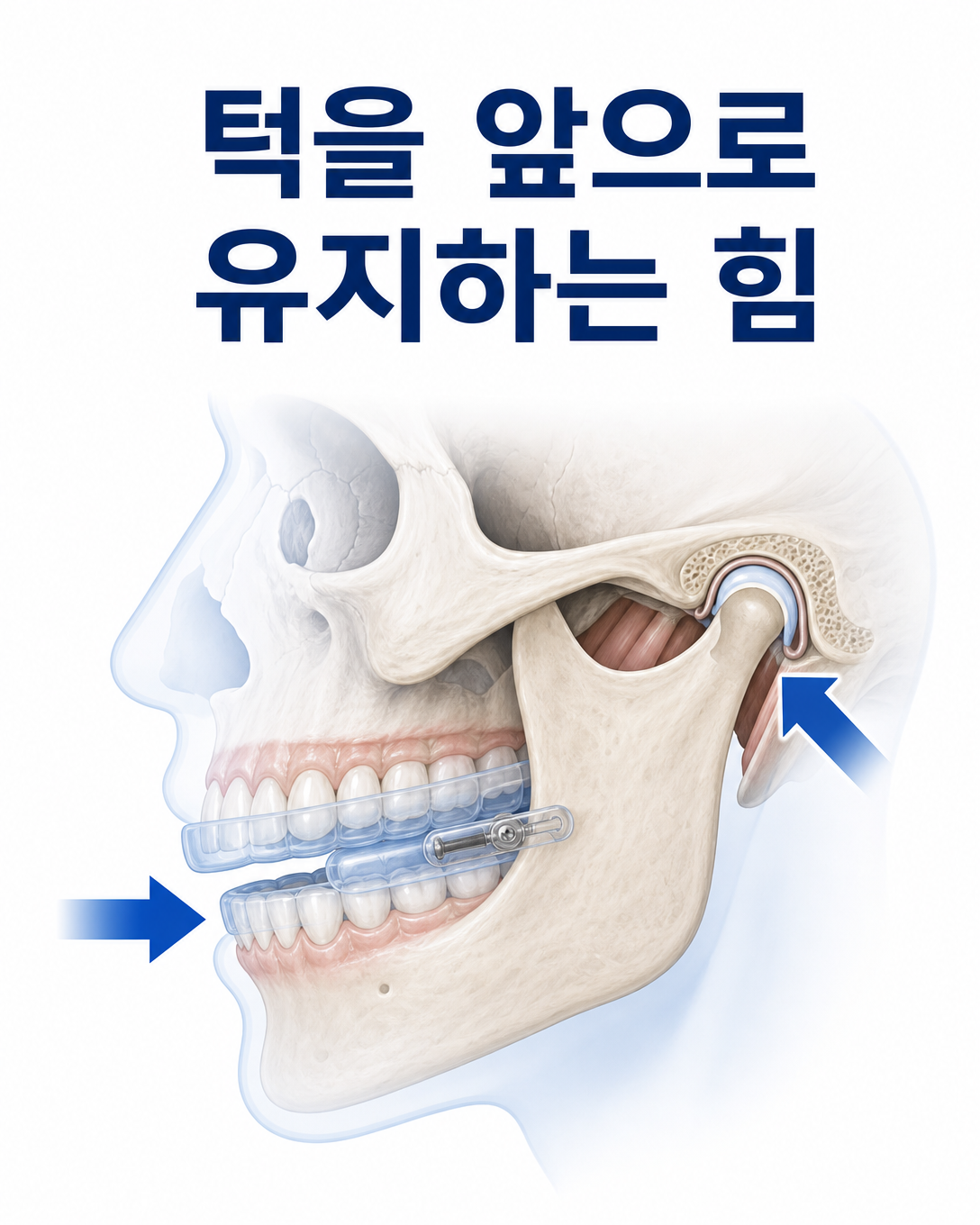 하악전진형 구강장치가 아래턱과 치아에 힘을 전달하는 원리를 나타낸 도식